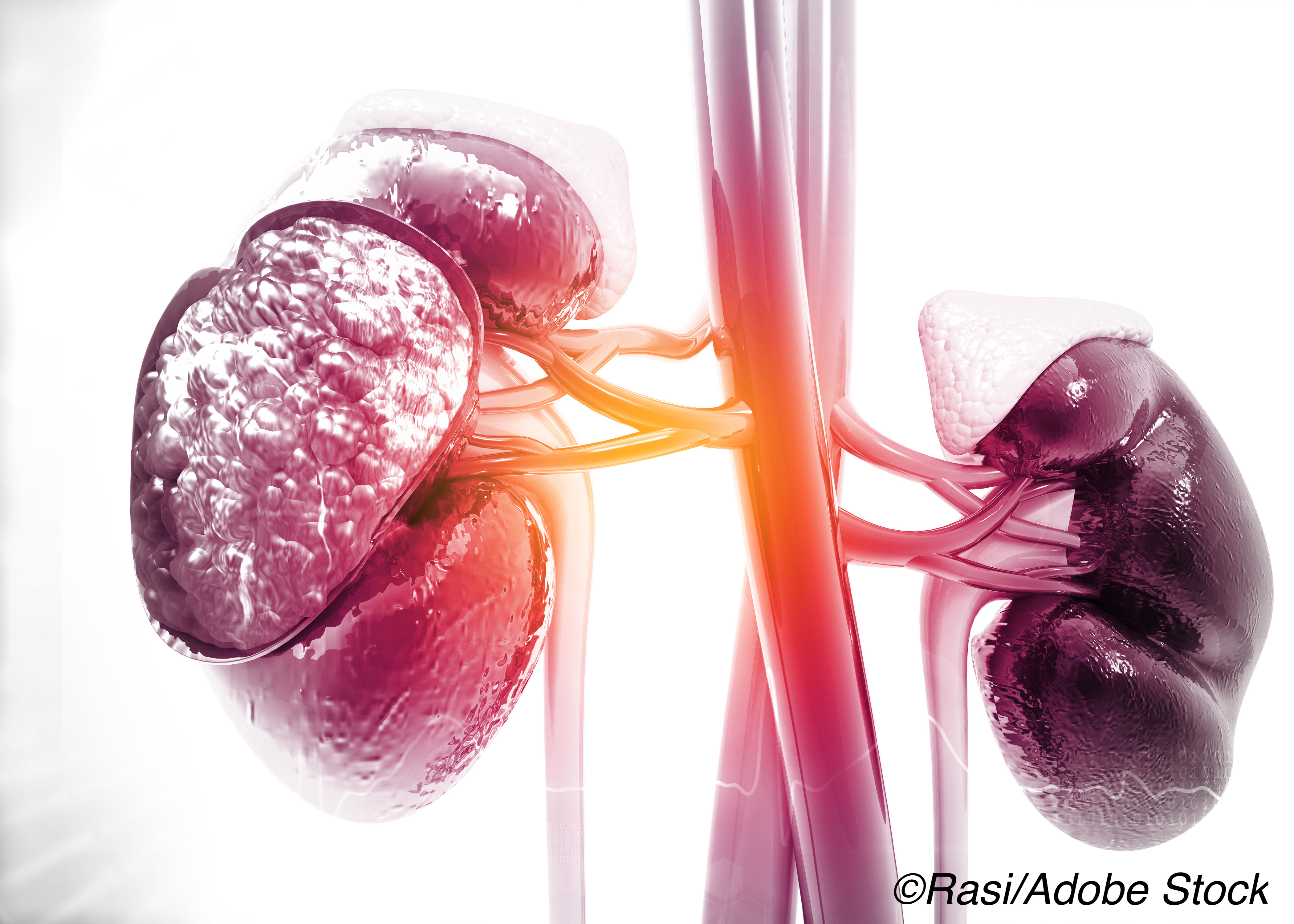 Despite Lowering Serum Urate Levels, Allopurinol Does Not Slow Kidney Decline in Type 1 Diabetes