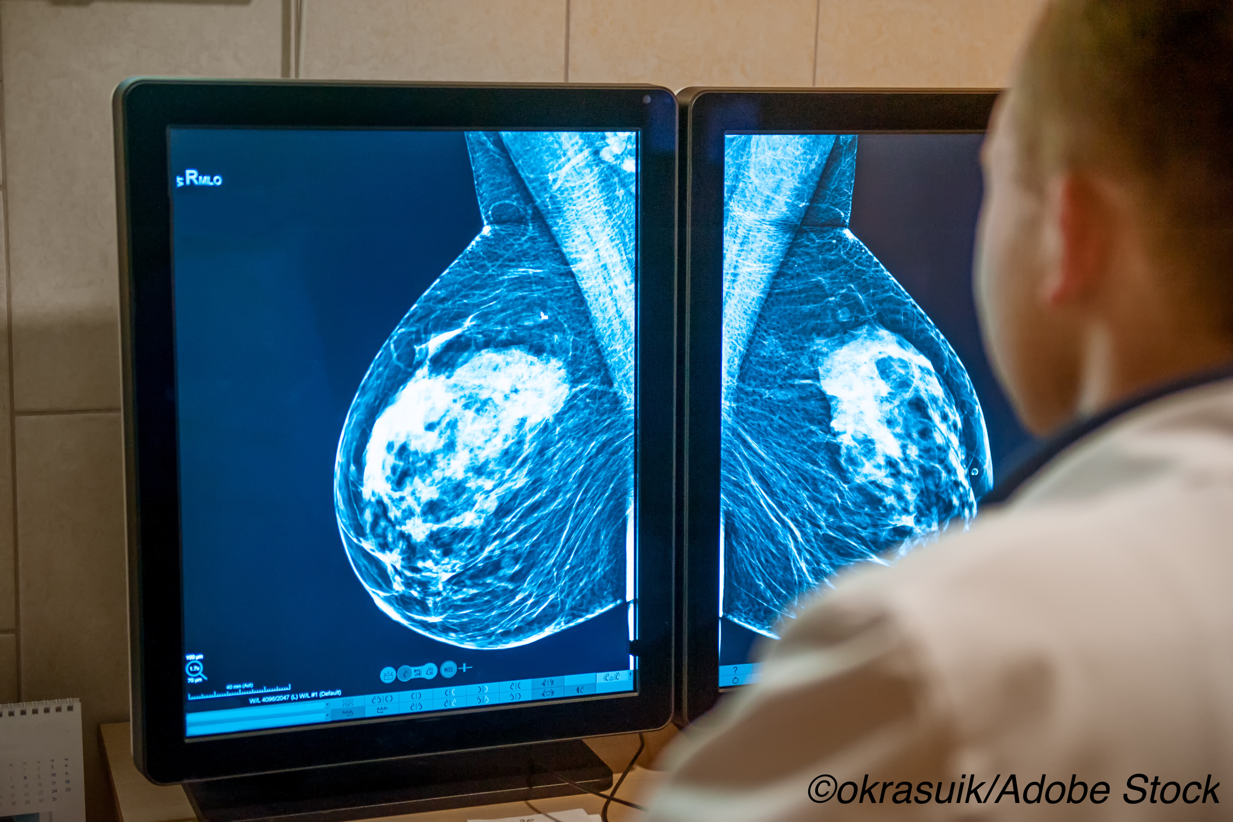 Higher Mortality Seen in Breast Cancers Diagnosed Soon After Negative Screening
