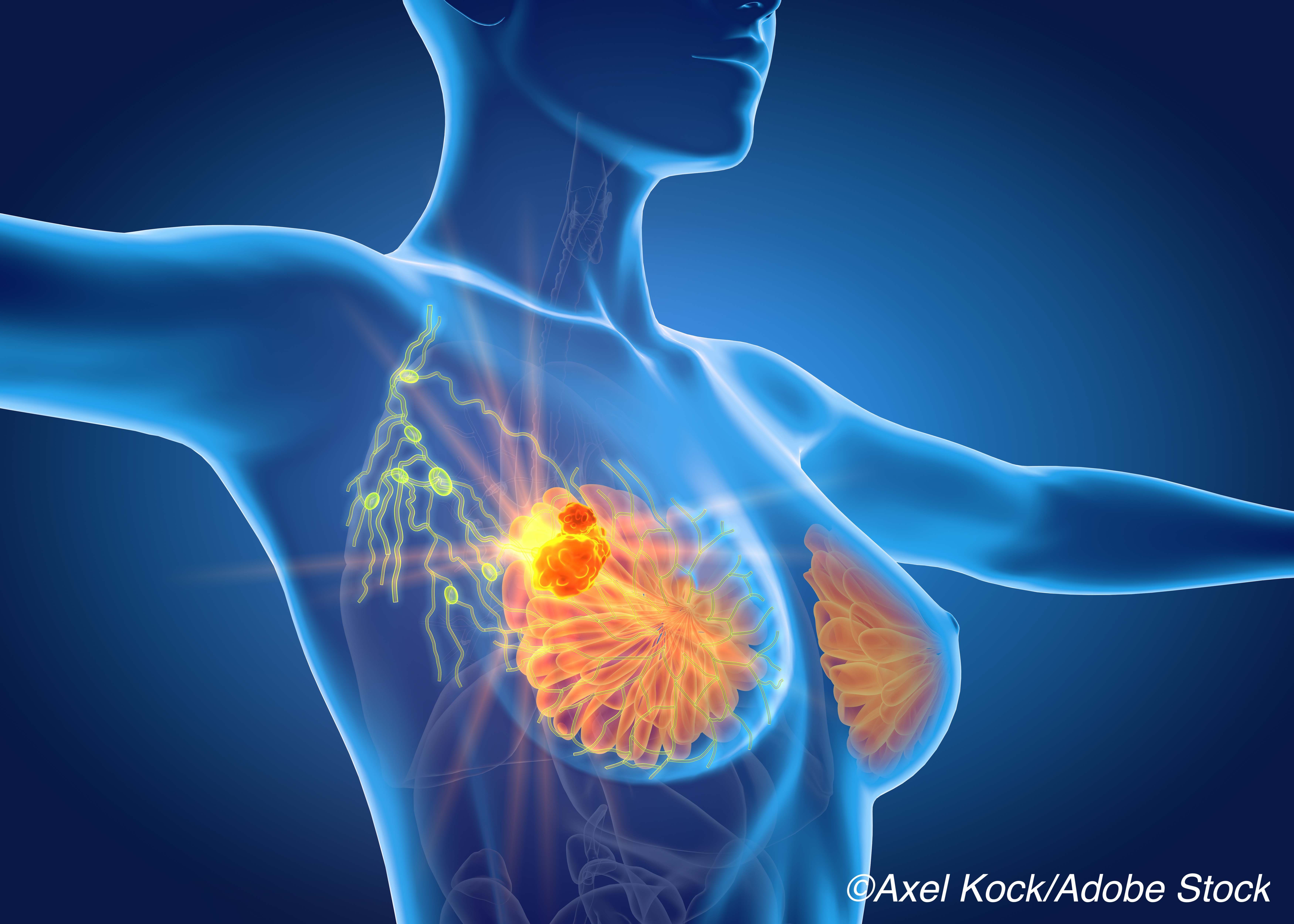 Pathologic Complete Response with Neoadjuvant TX Associated with Outstanding Breast Ca Outcomes