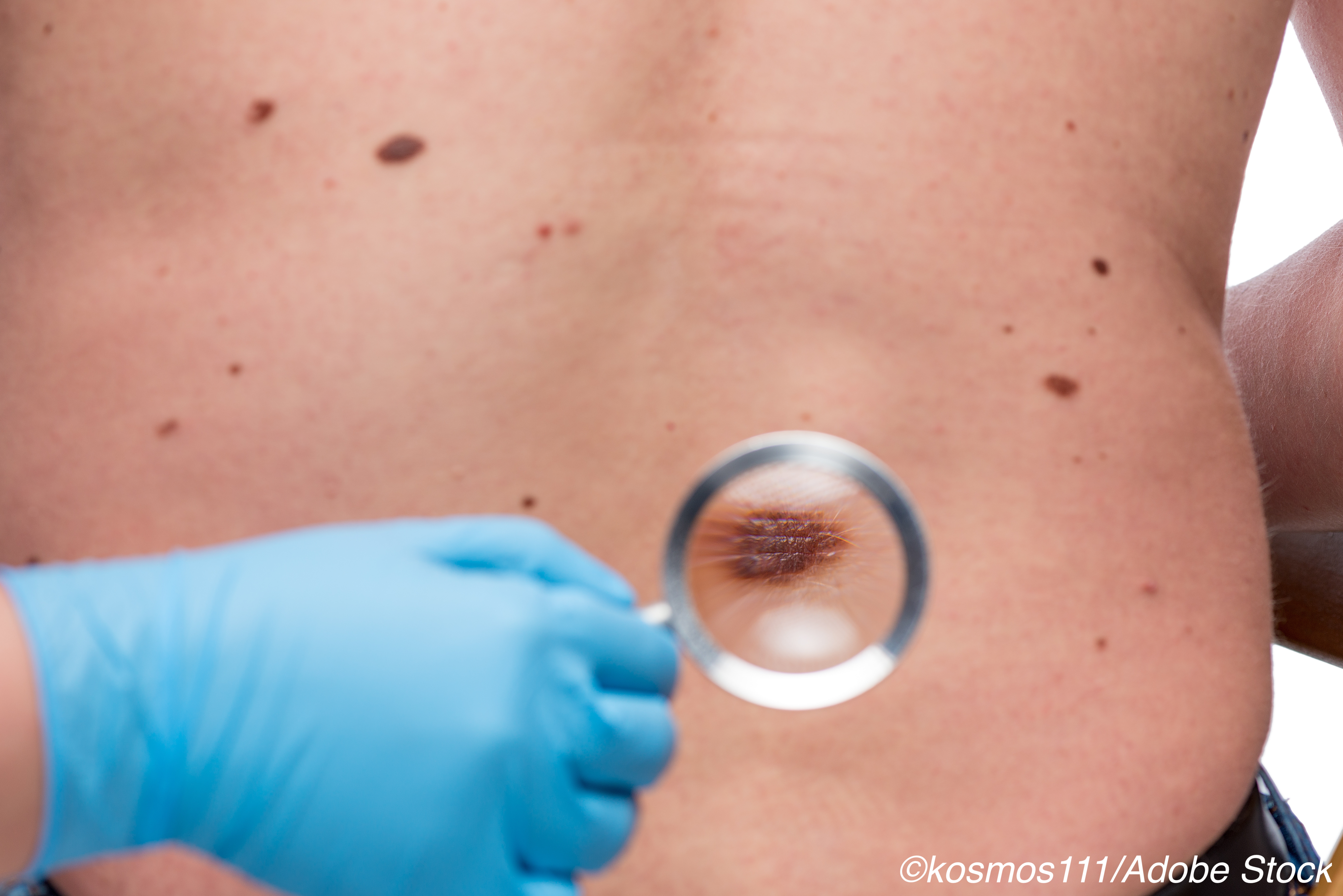 GEP Tests Fail to ID Recurrence Risk in Cutaneous Melanoma