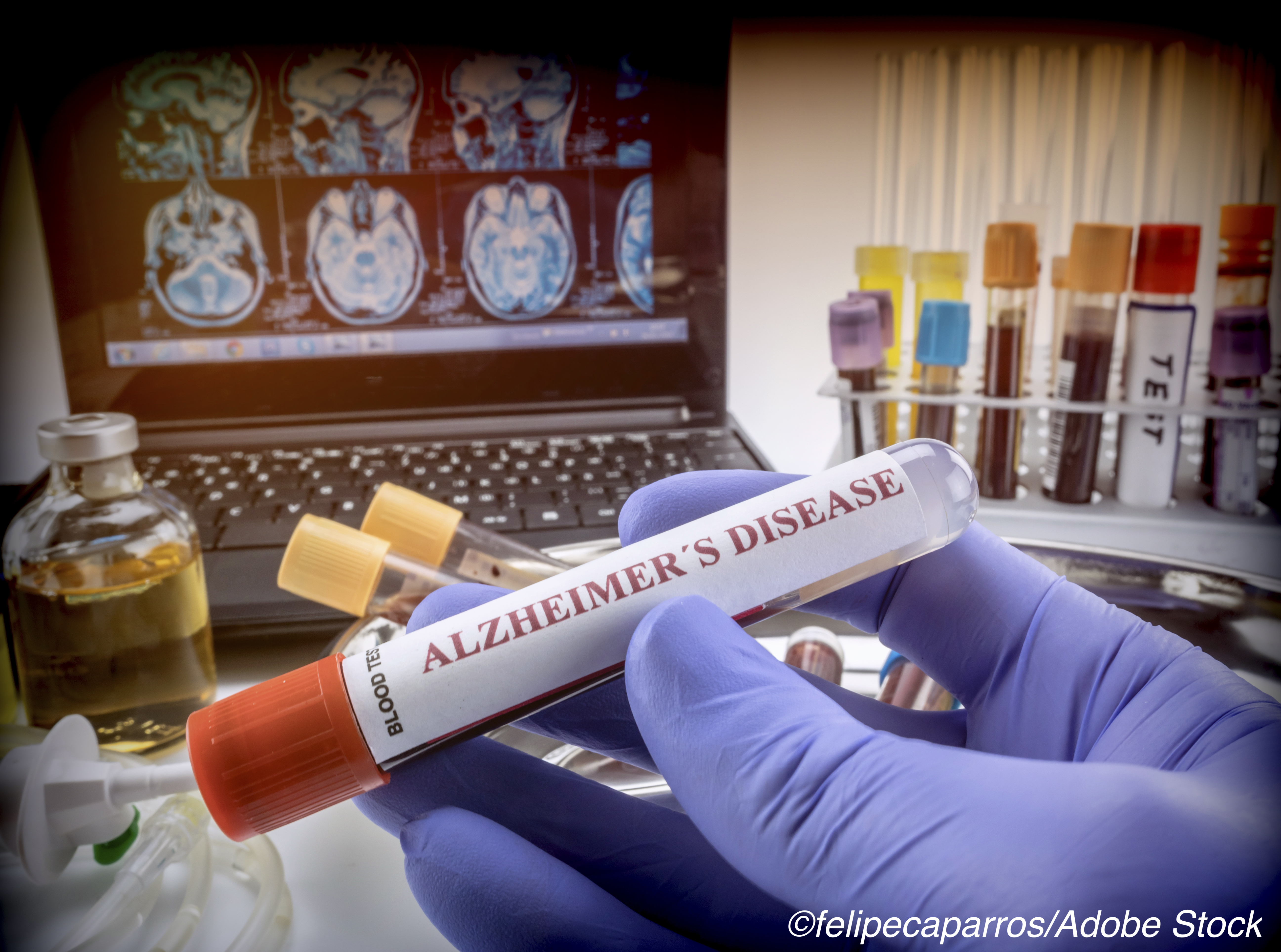 Could a Blood Test Confirm Alzheimer’s Disease?