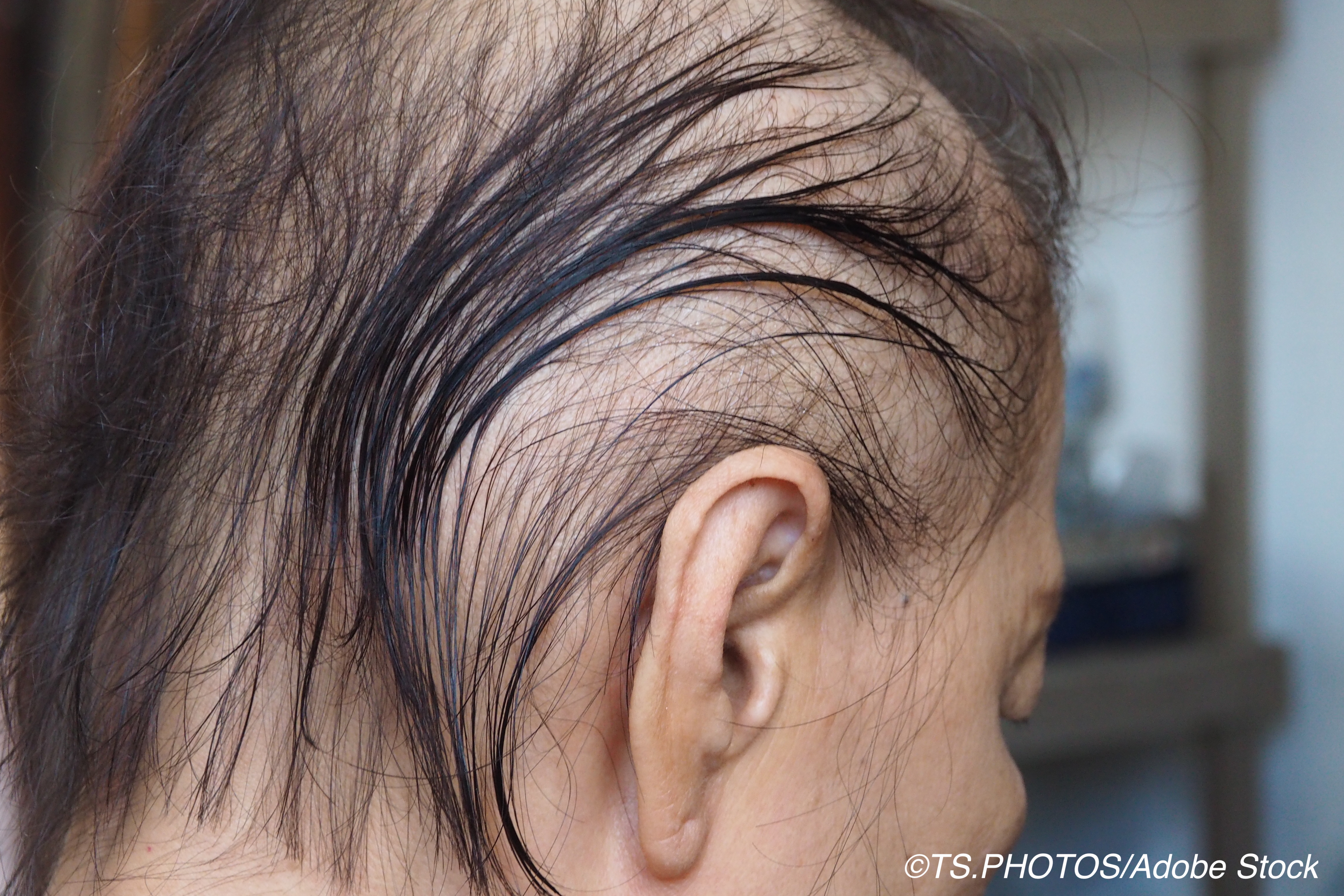 Minoxidil 5% May Help Counter Radiation-Induced Hair Loss