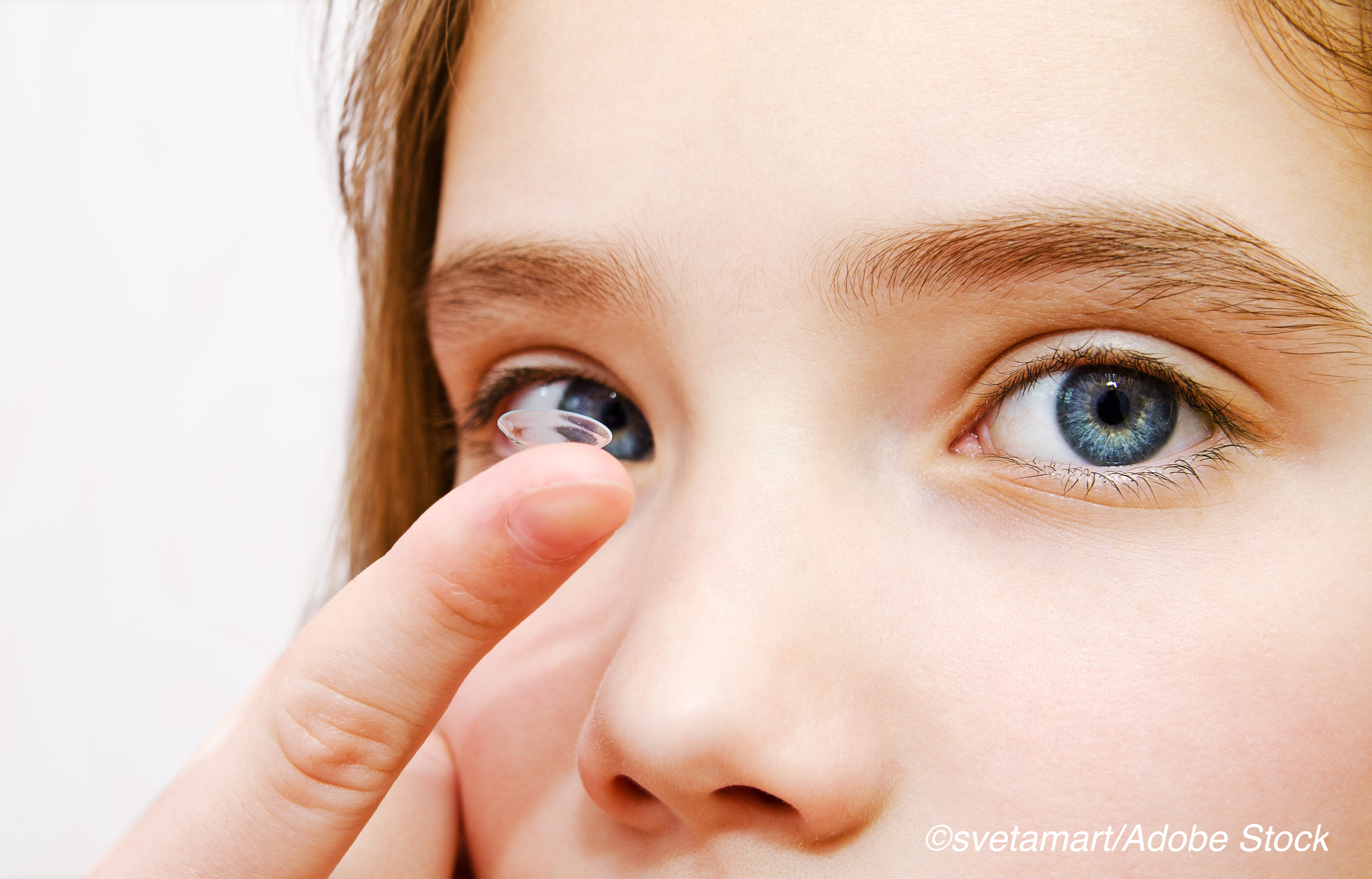 Children with Myopia See Slower Progression Rate with Soft Contact Lens