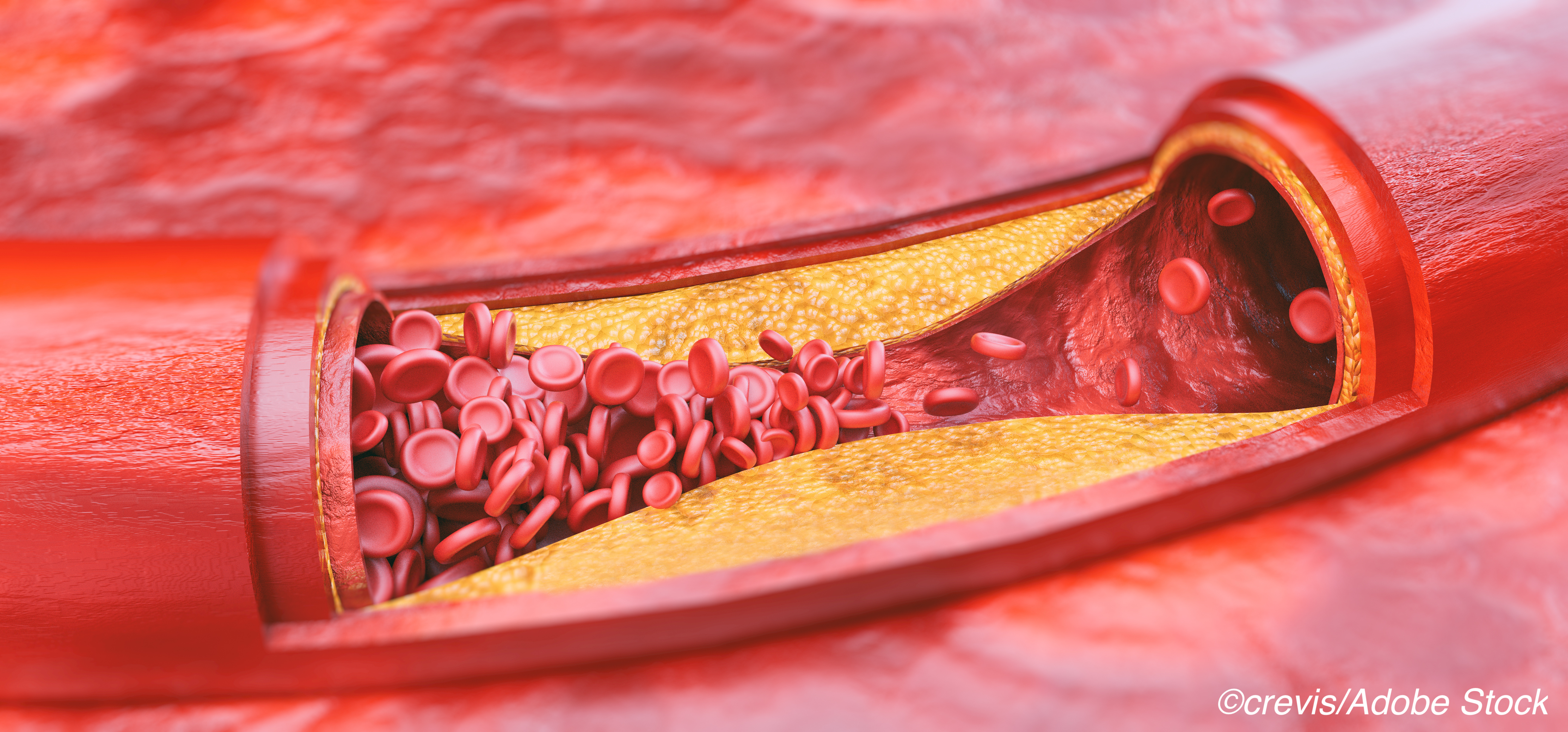 CPC Tied to Renal Insufficiency in Older CAD Patients
