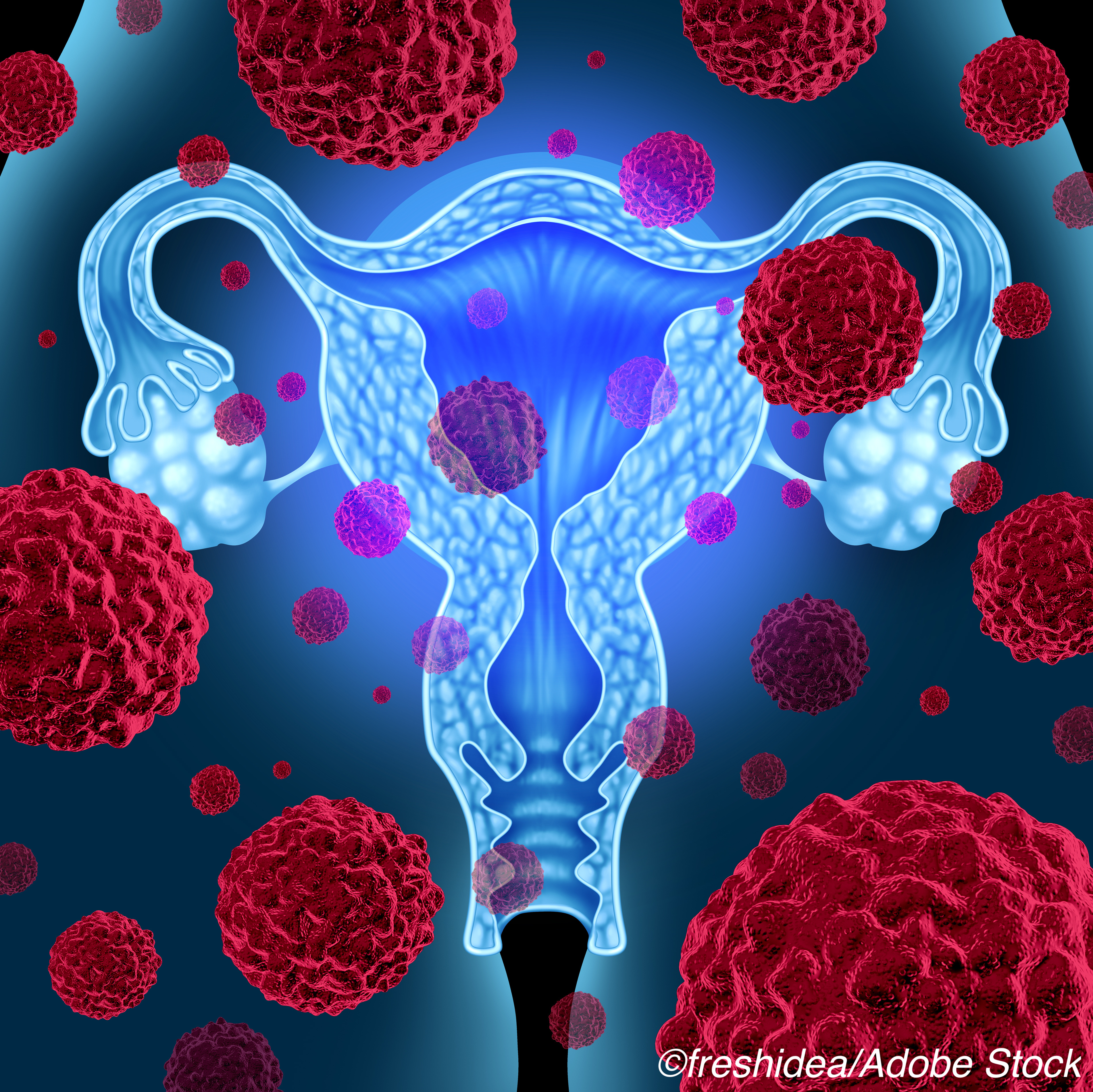 HIPEC Added to PCS Benefits Patients with Stage III Epithelial Ovarian Cancer
