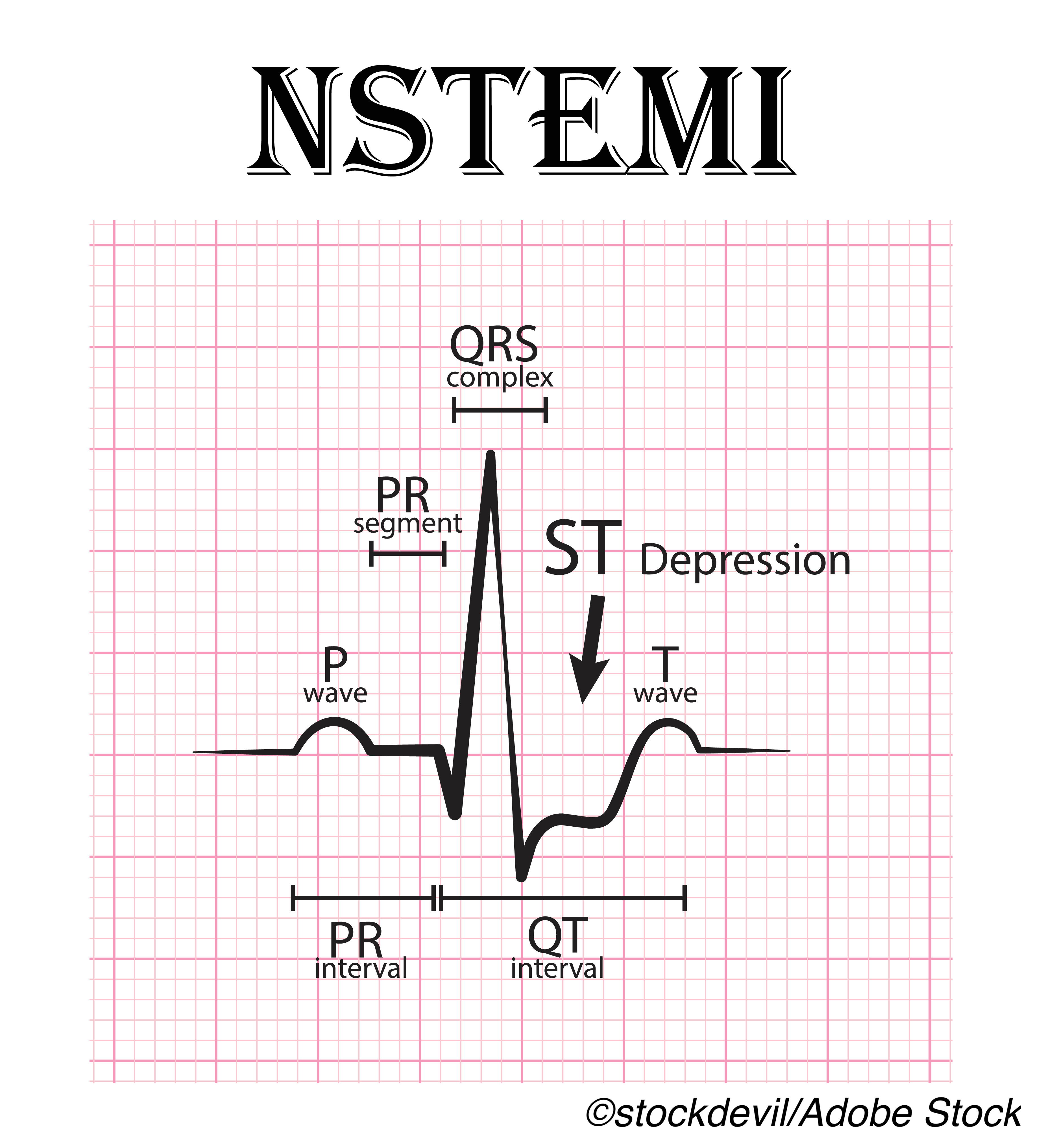 Mortality Benefit for Invasive NSTEMI Strategy Holds Over Age 80