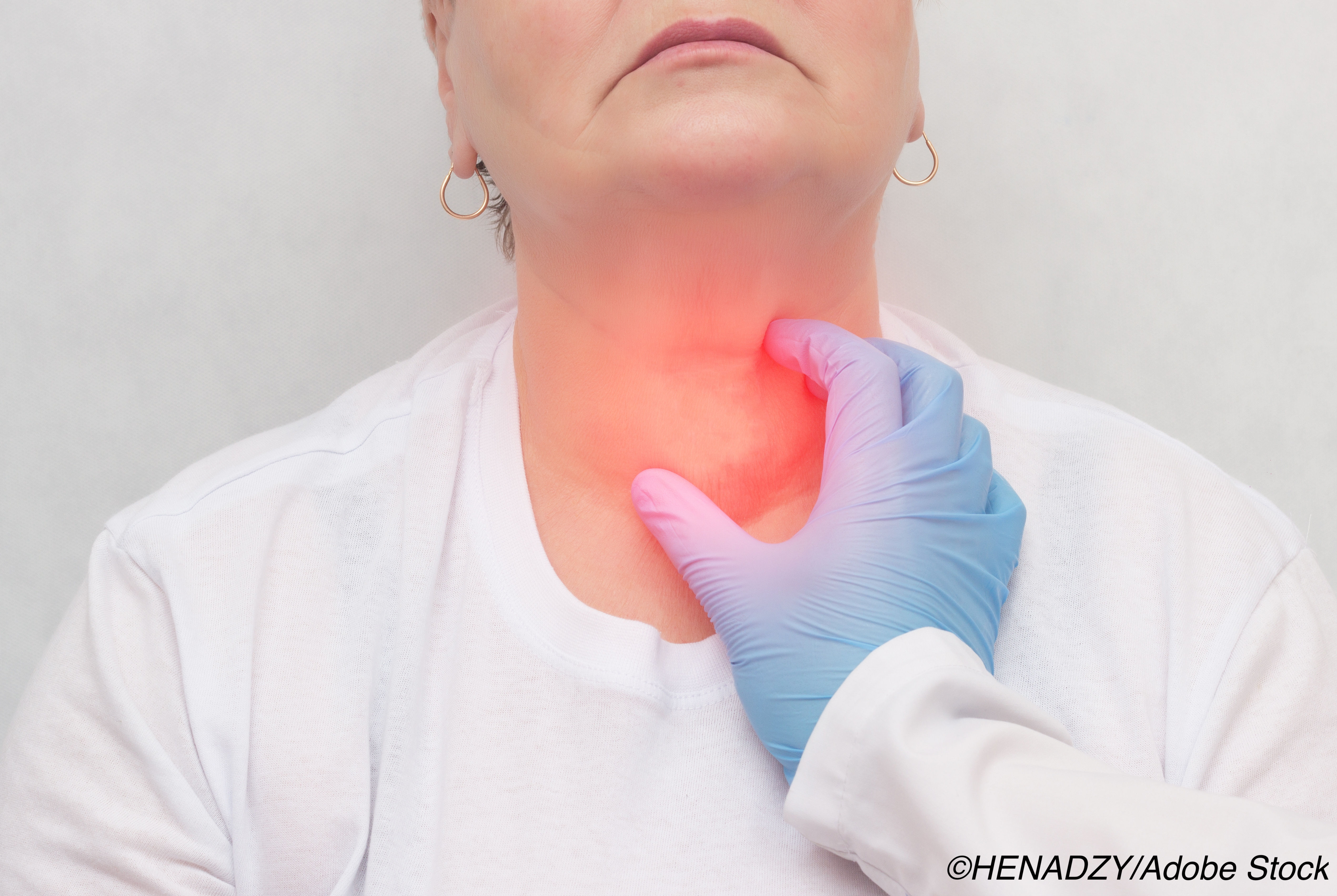 ACTRIMS-ECTRIMS: Thyroid Disorders  Don’t Affect MS Control