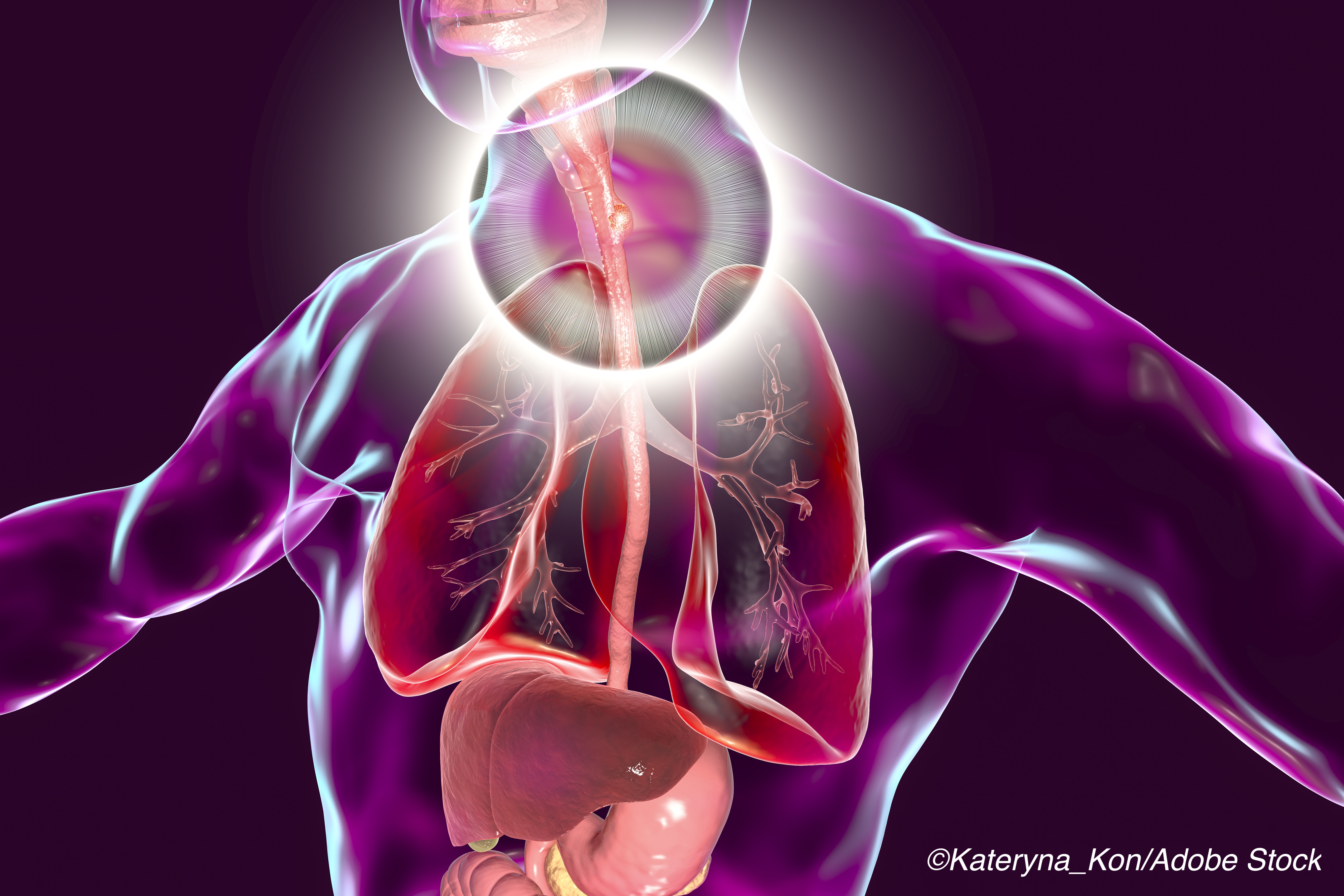 ESMO: Immunotherapy Improves Gastric Cancer Outcomes