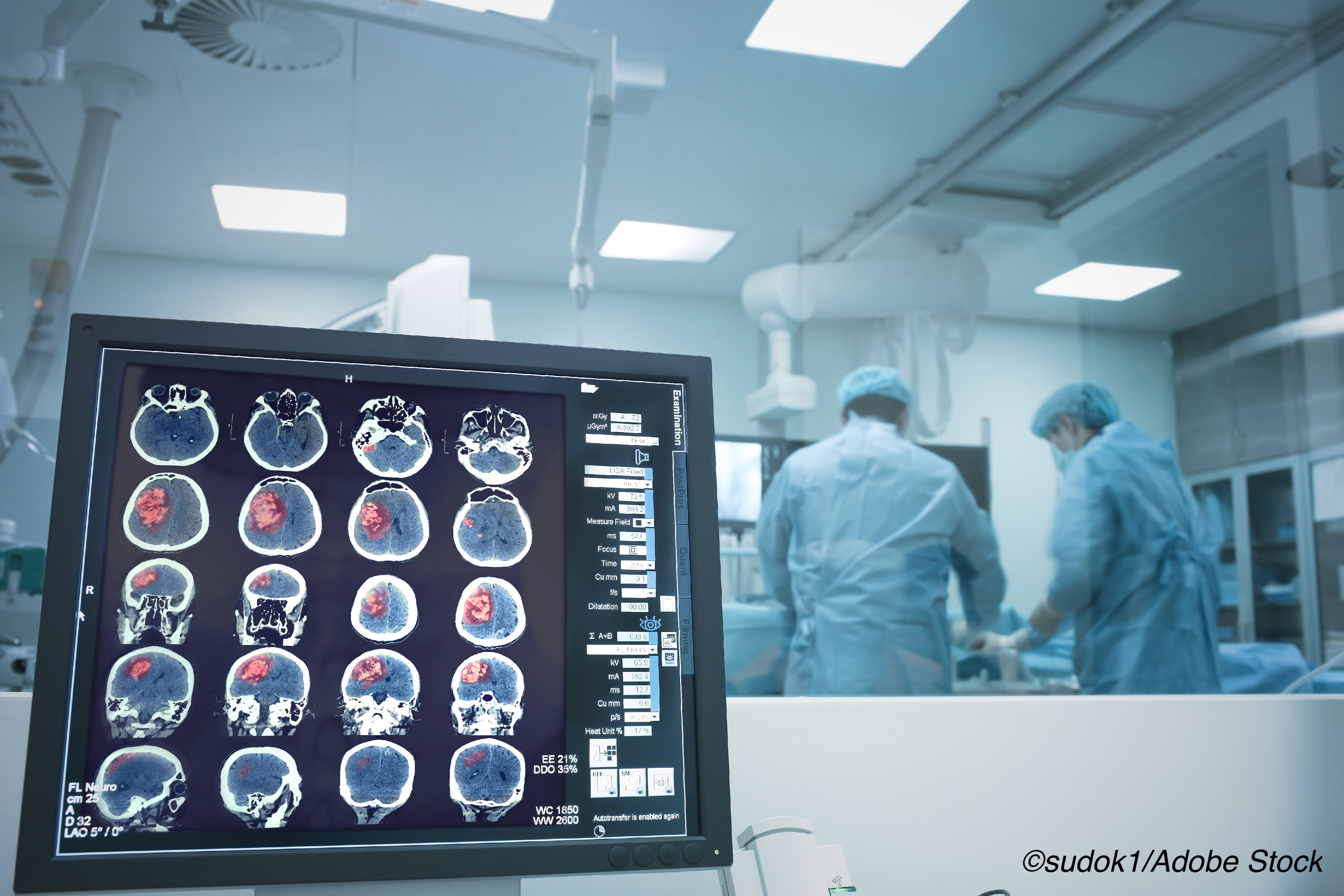 In-Hospital Stroke Associated with Worse Outcomes