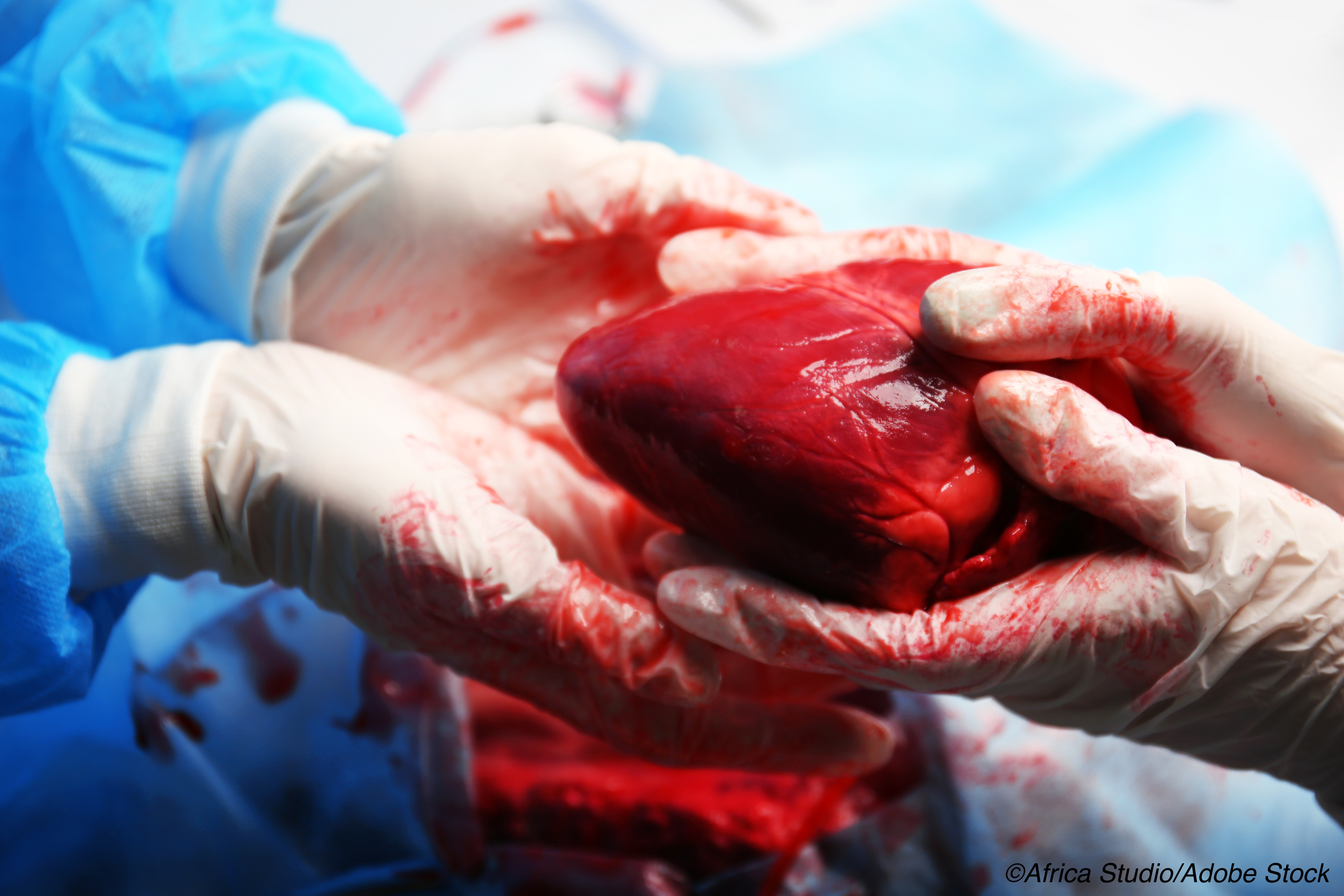Heart Transplant: UNOS Policy Cut Wait Times, Mortality, but Post-transplant Survival Increased