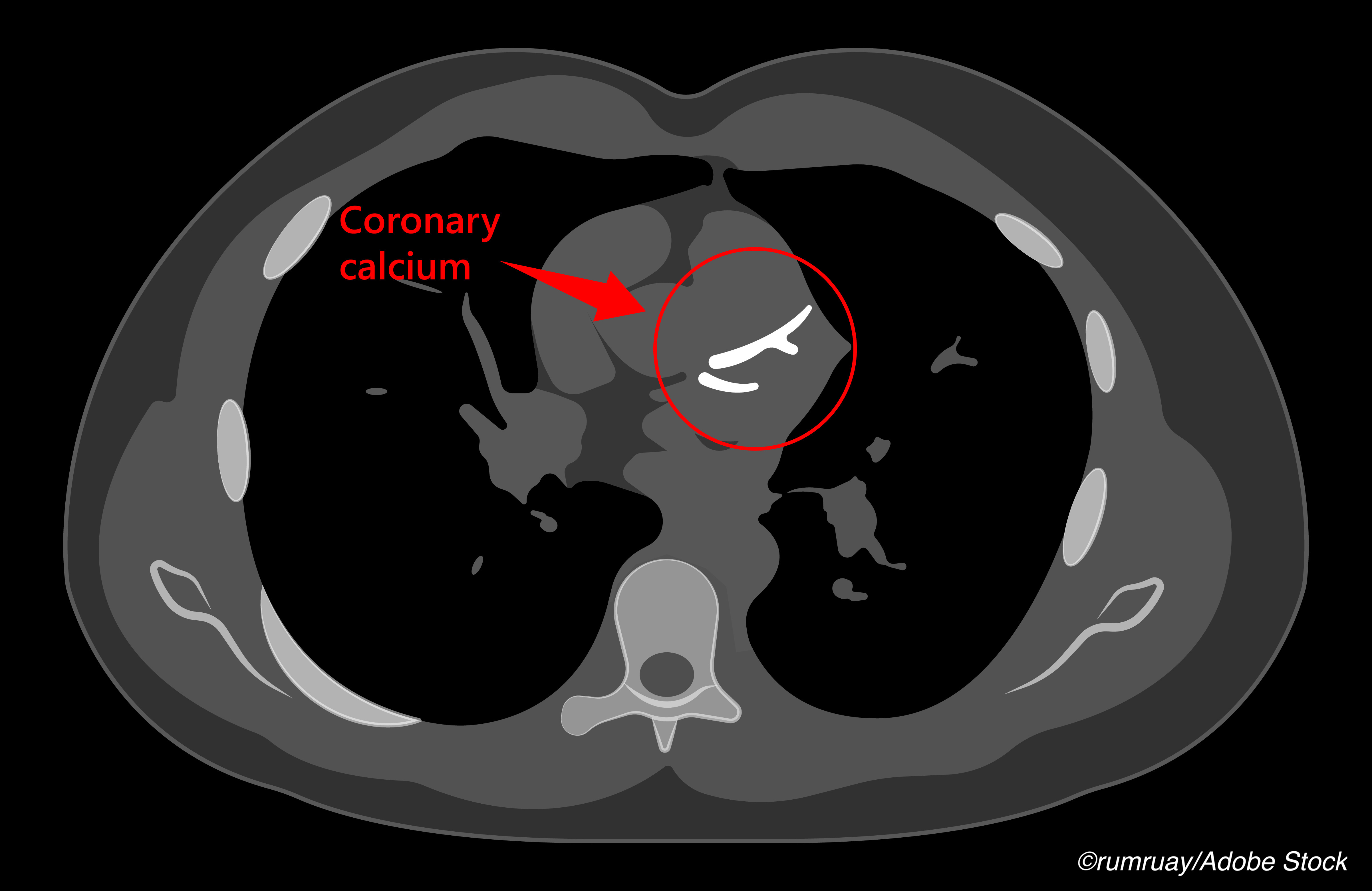The Calcified Plaque Density Conundrum
