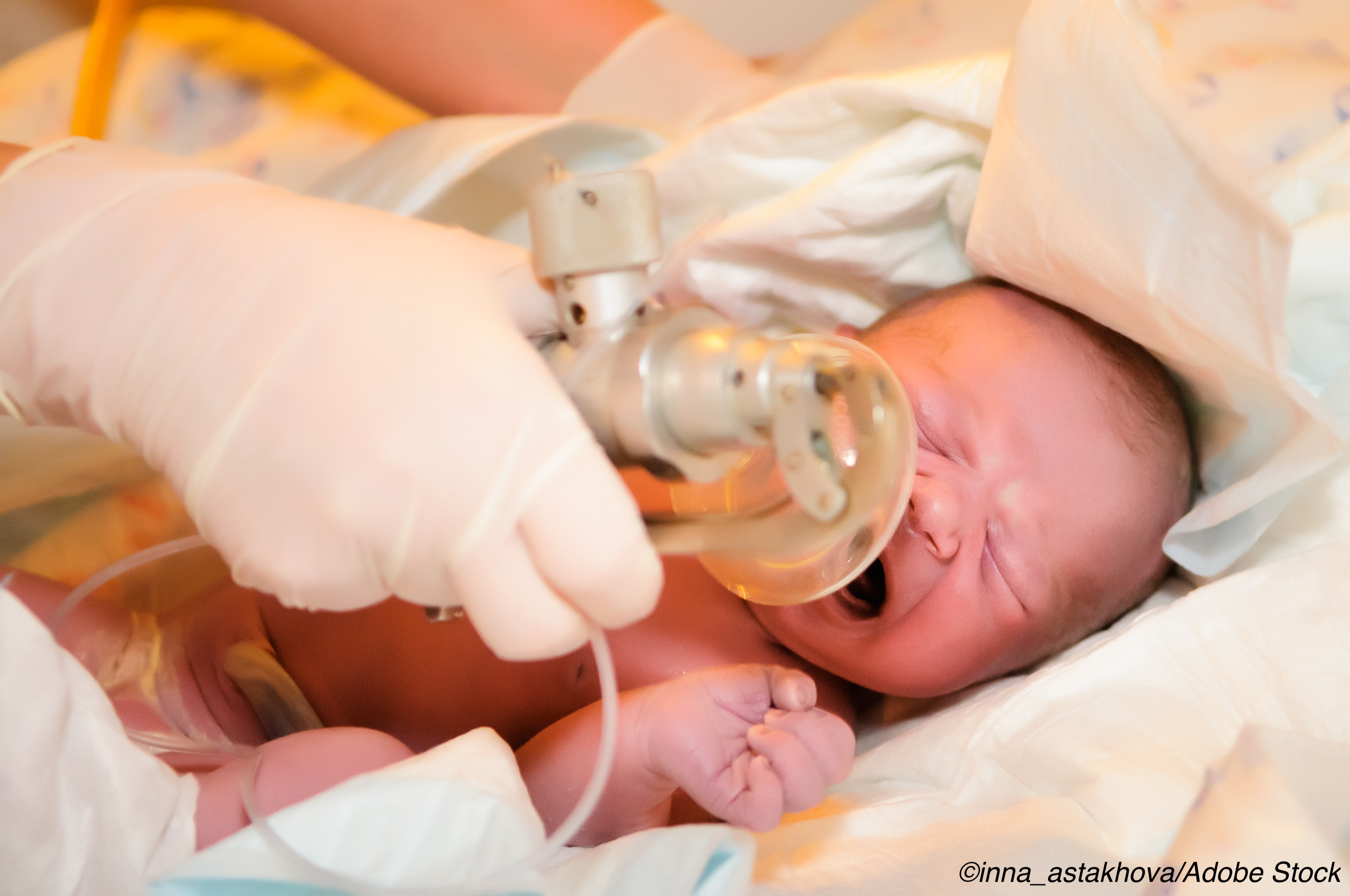 Laryngeal Mask Airway Shown To Be Safe Option For Newborn Resuscitation Physician S Weekly