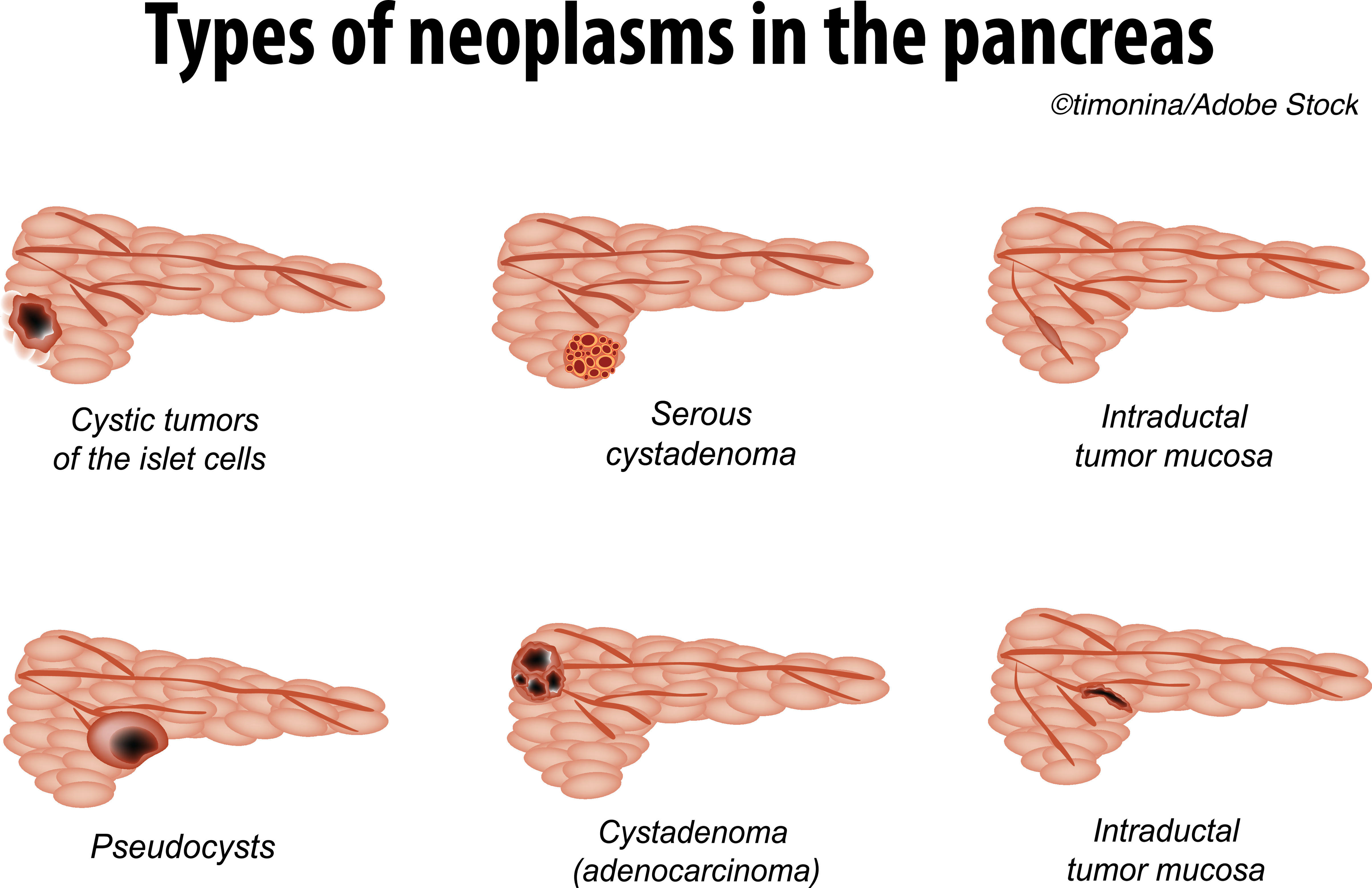 Study Questions Predictive Value Of Size For Pancreatic Cyst 