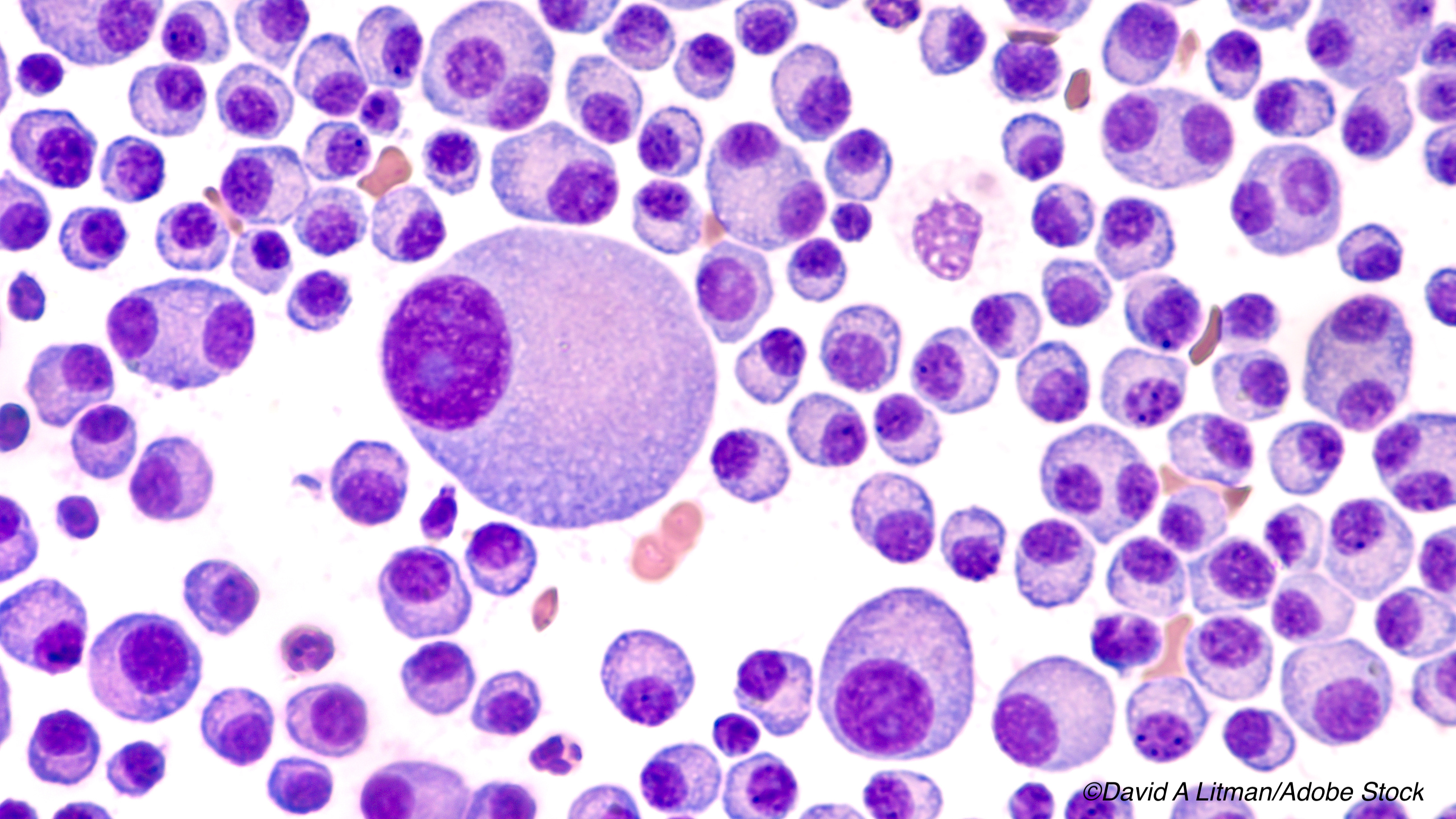ASH: Multiple Myeloma Cases to Rise by 13% in Five Years