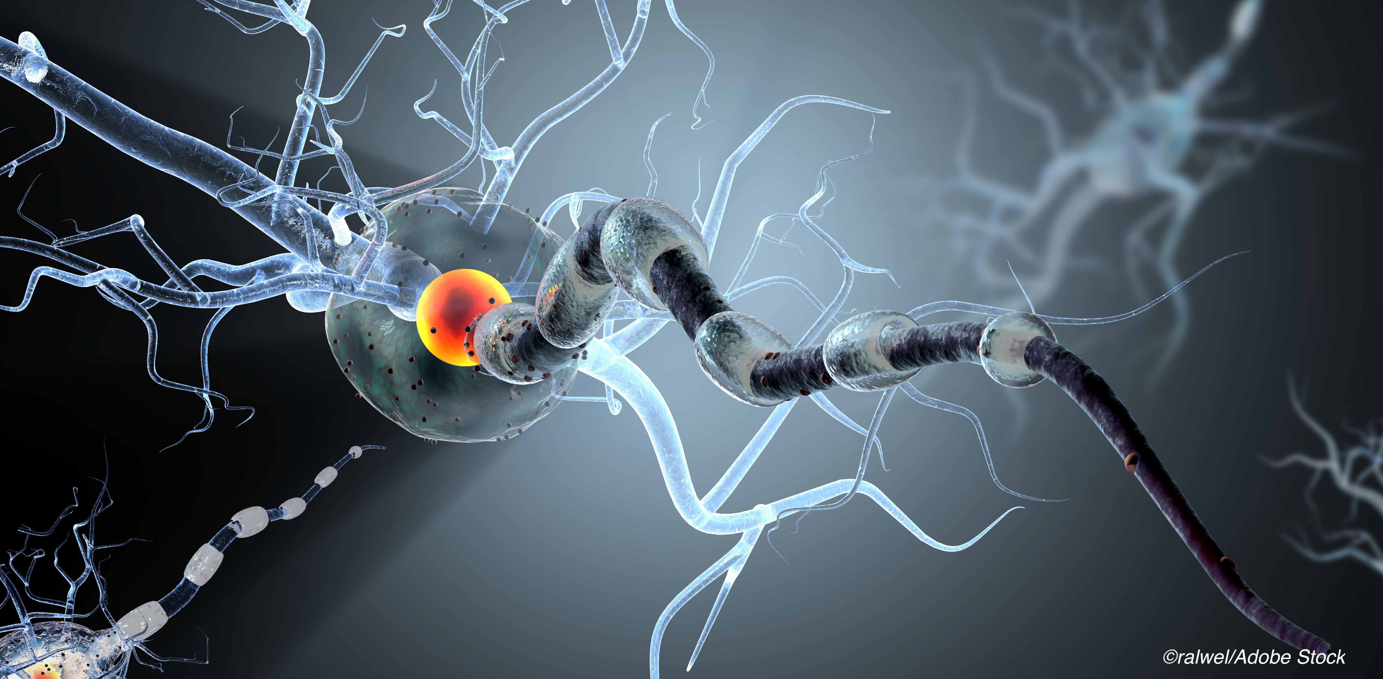Siponimod May Have Cognitive Benefit in Secondary Progressive MS