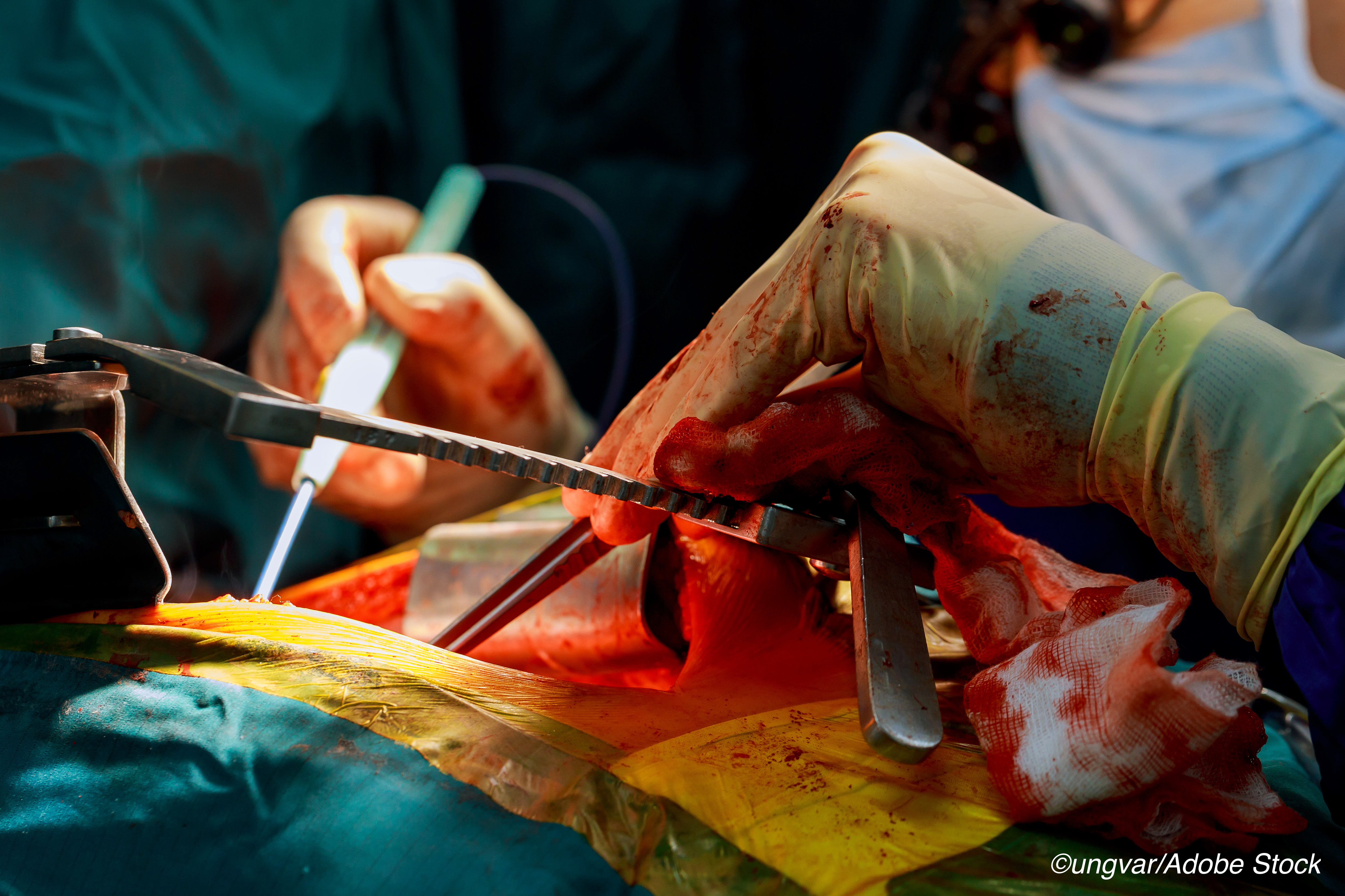 Frailty Tied to Gender Gap in Liver Transplant Wait-List Mortality