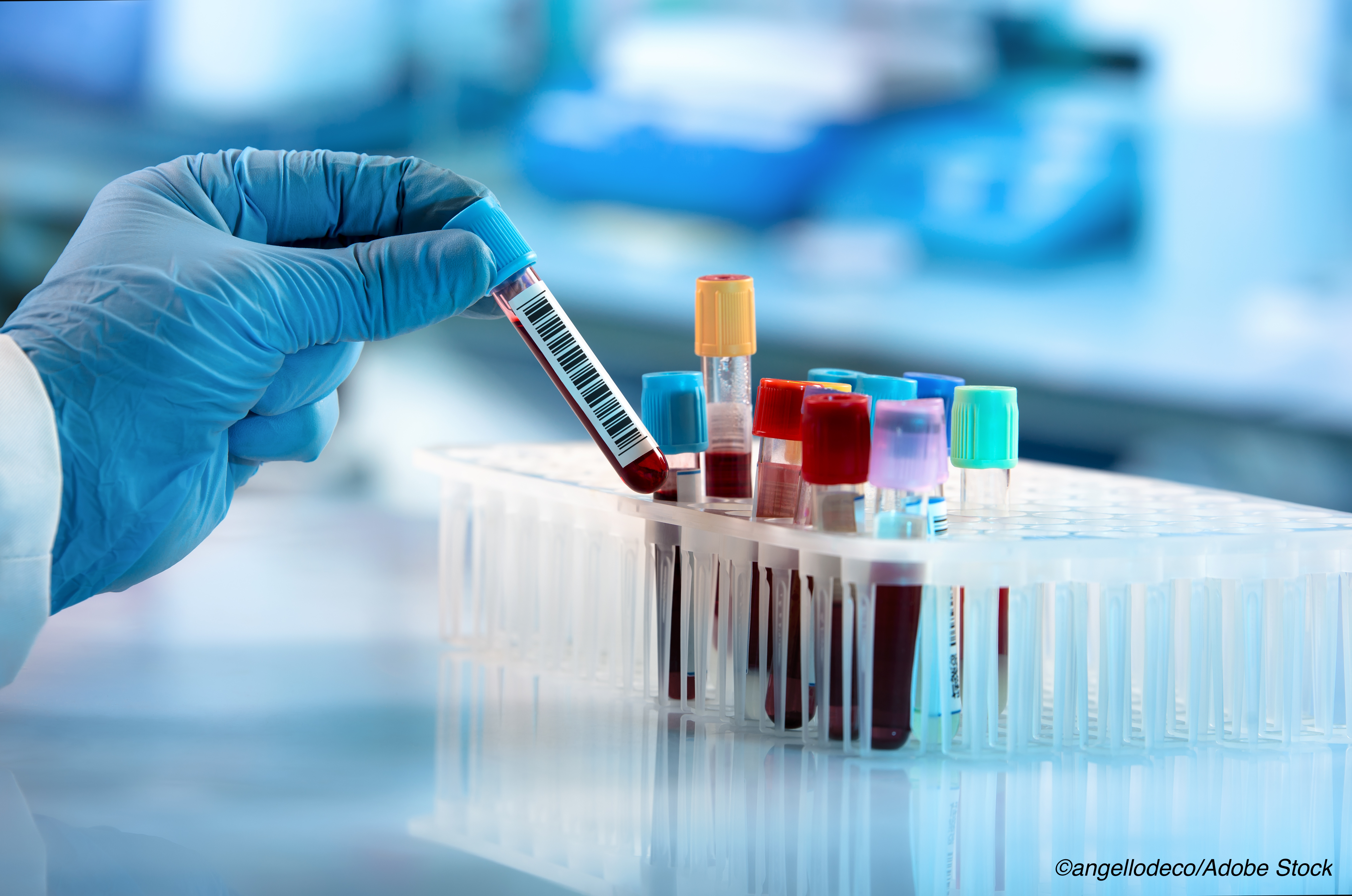 Blood Test to Detect Psychogenic Nonepileptic Seizures Shows Promise