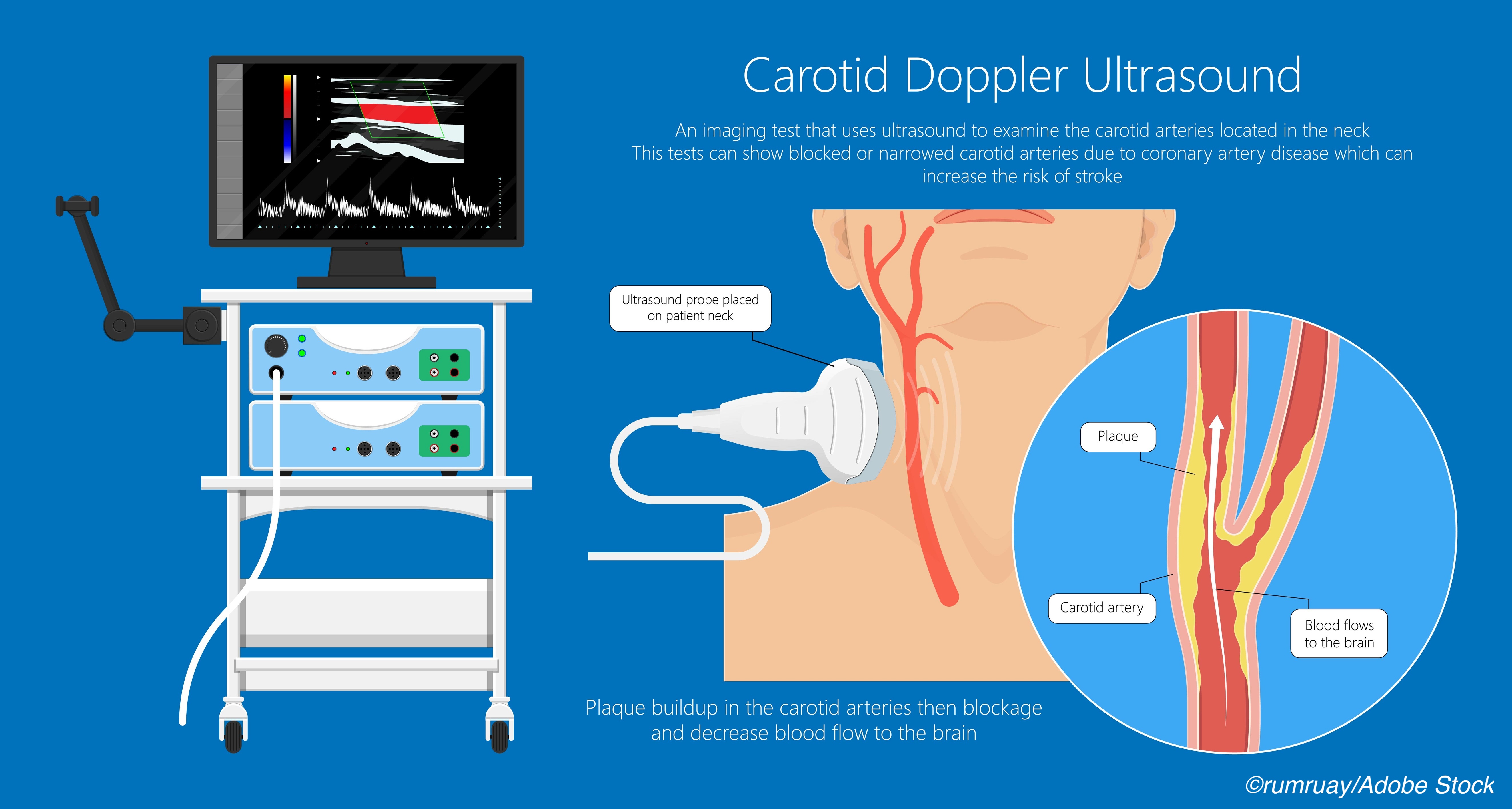 Does Carotid Stenosis Cause Pain