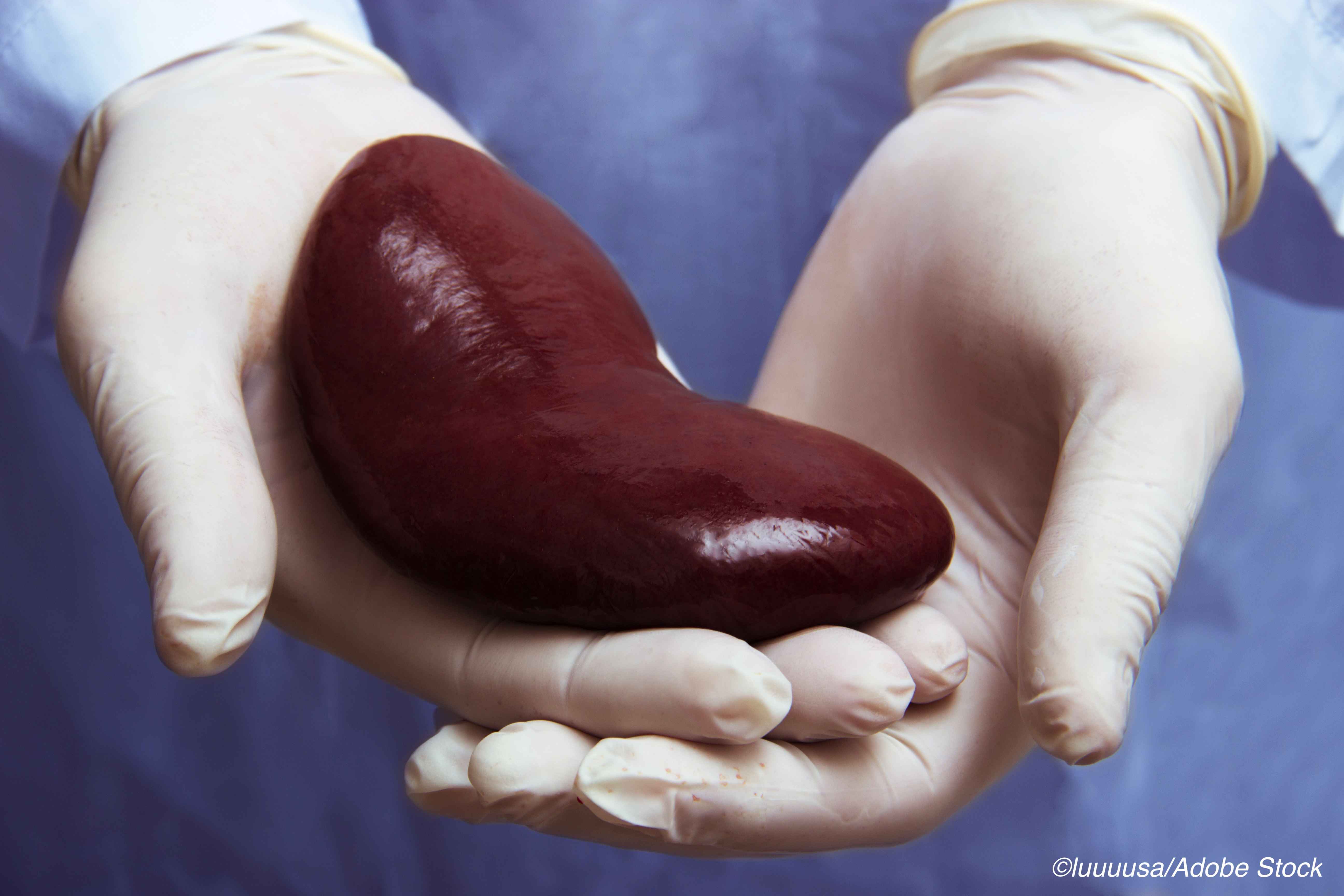 Long-Term Corticosteroids Not Necessary After Kidney Transplant