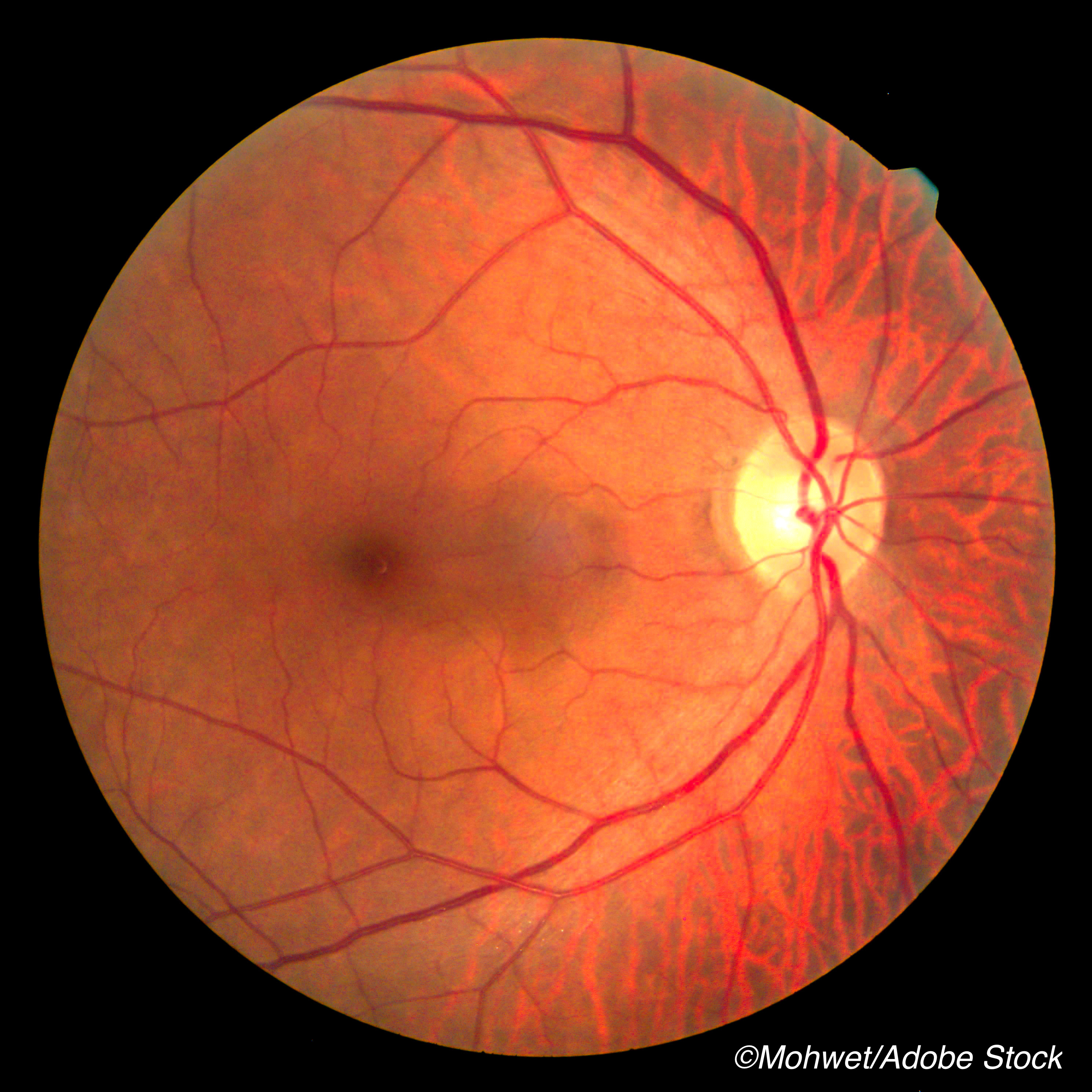 Retinal Thinning Portends Sickle Cell Retinopathy