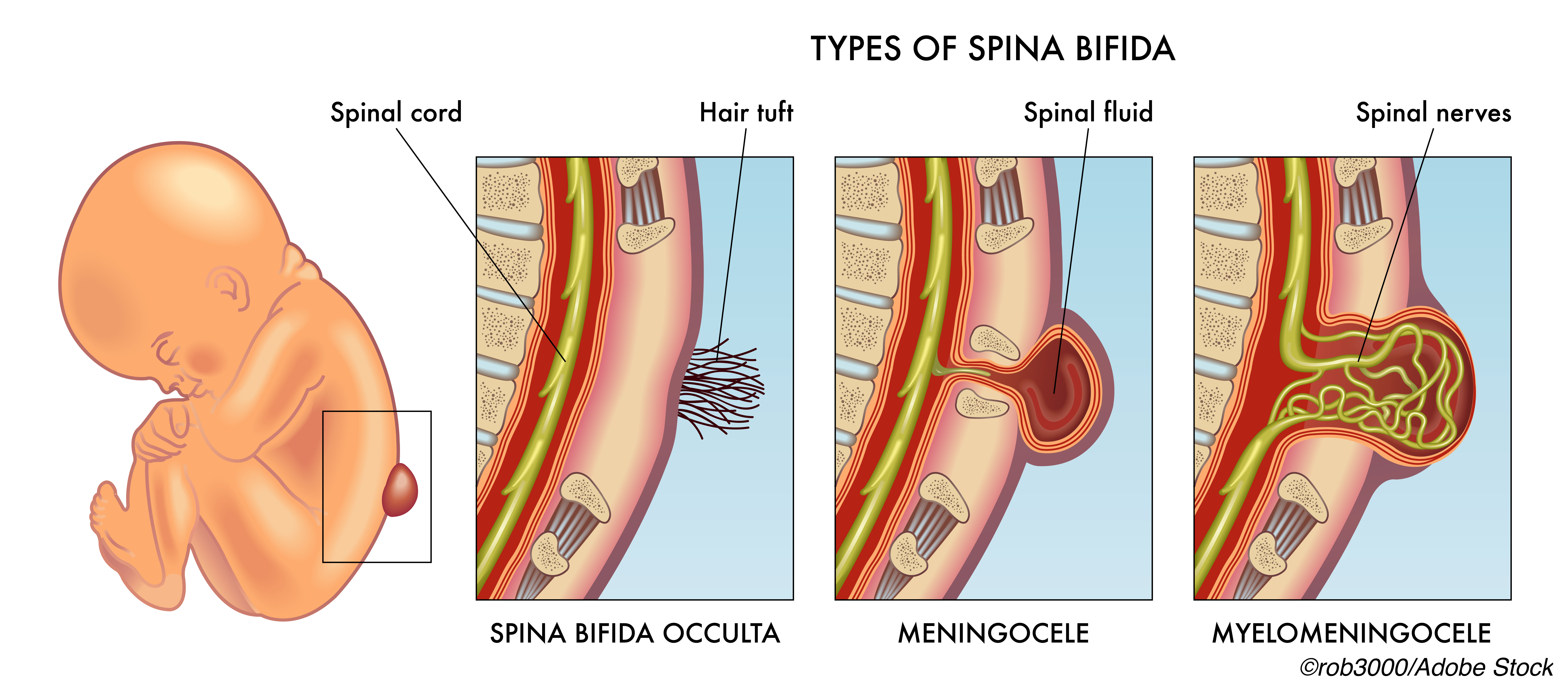 Spina Bifida Repair: The Sooner the Better