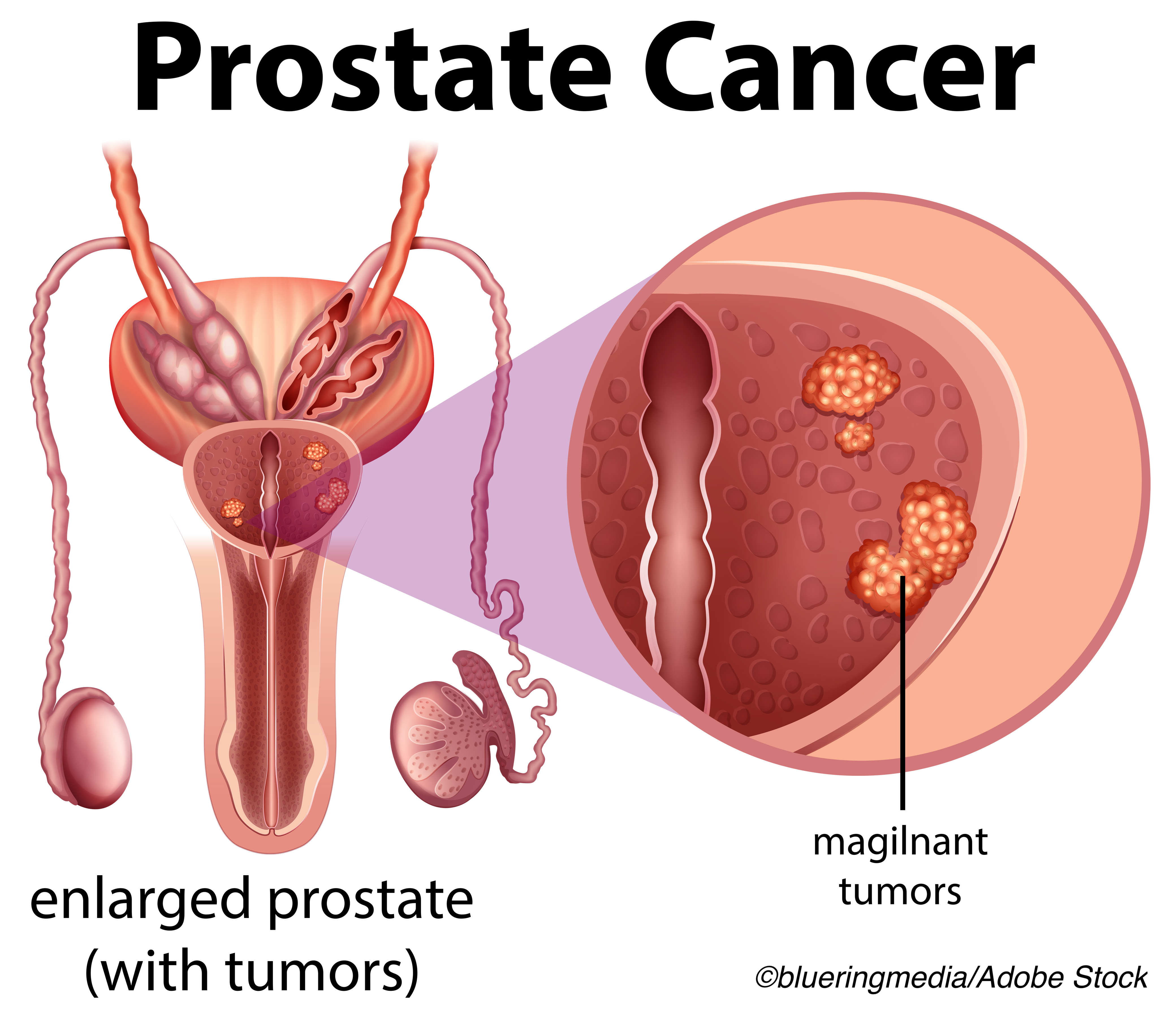 Prostate Cancer Multigene Biomarker Validated As Prognosticpredictive Test Physicians Weekly 3810