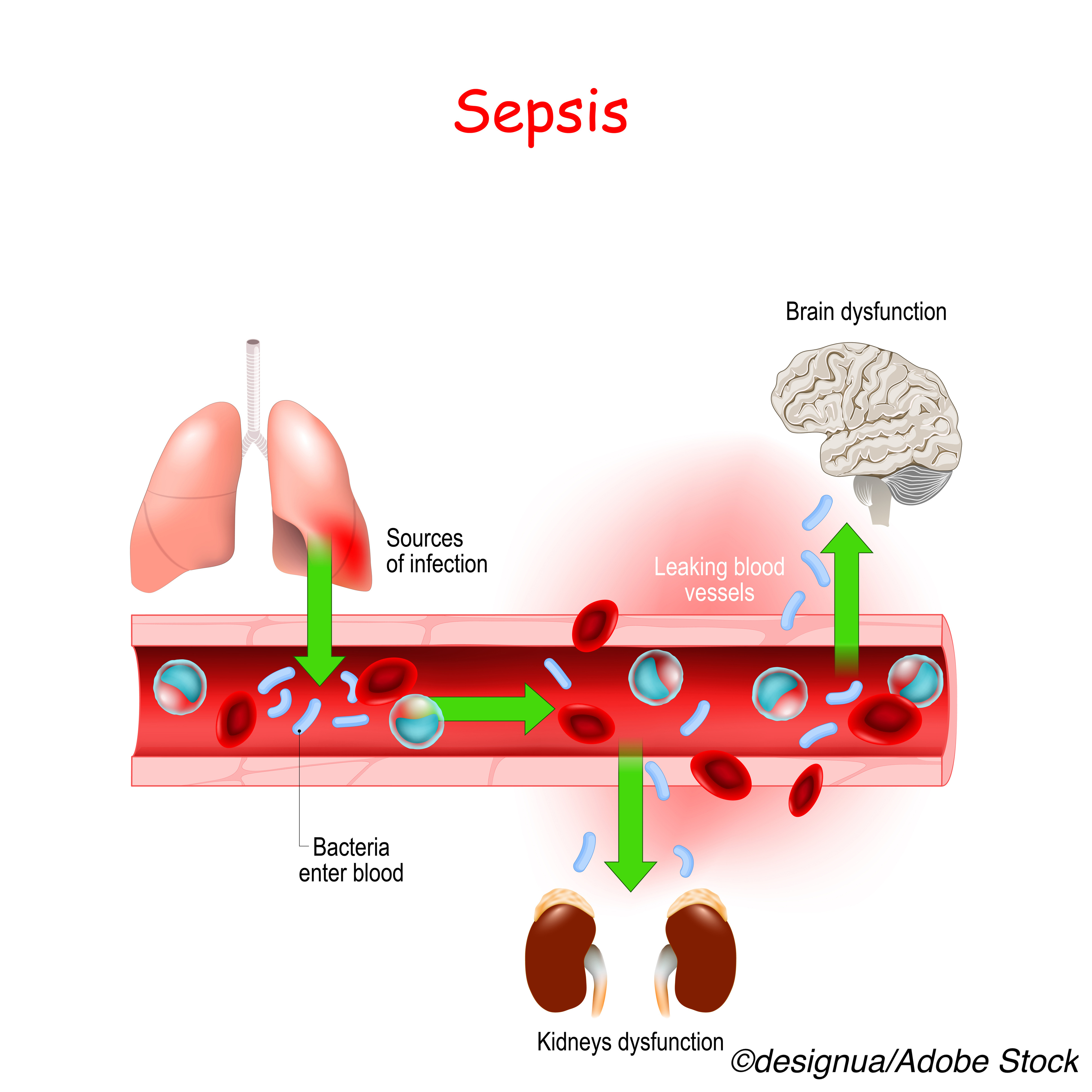 Vitamin-Driven Therapy for Sepsis Again Disappoints