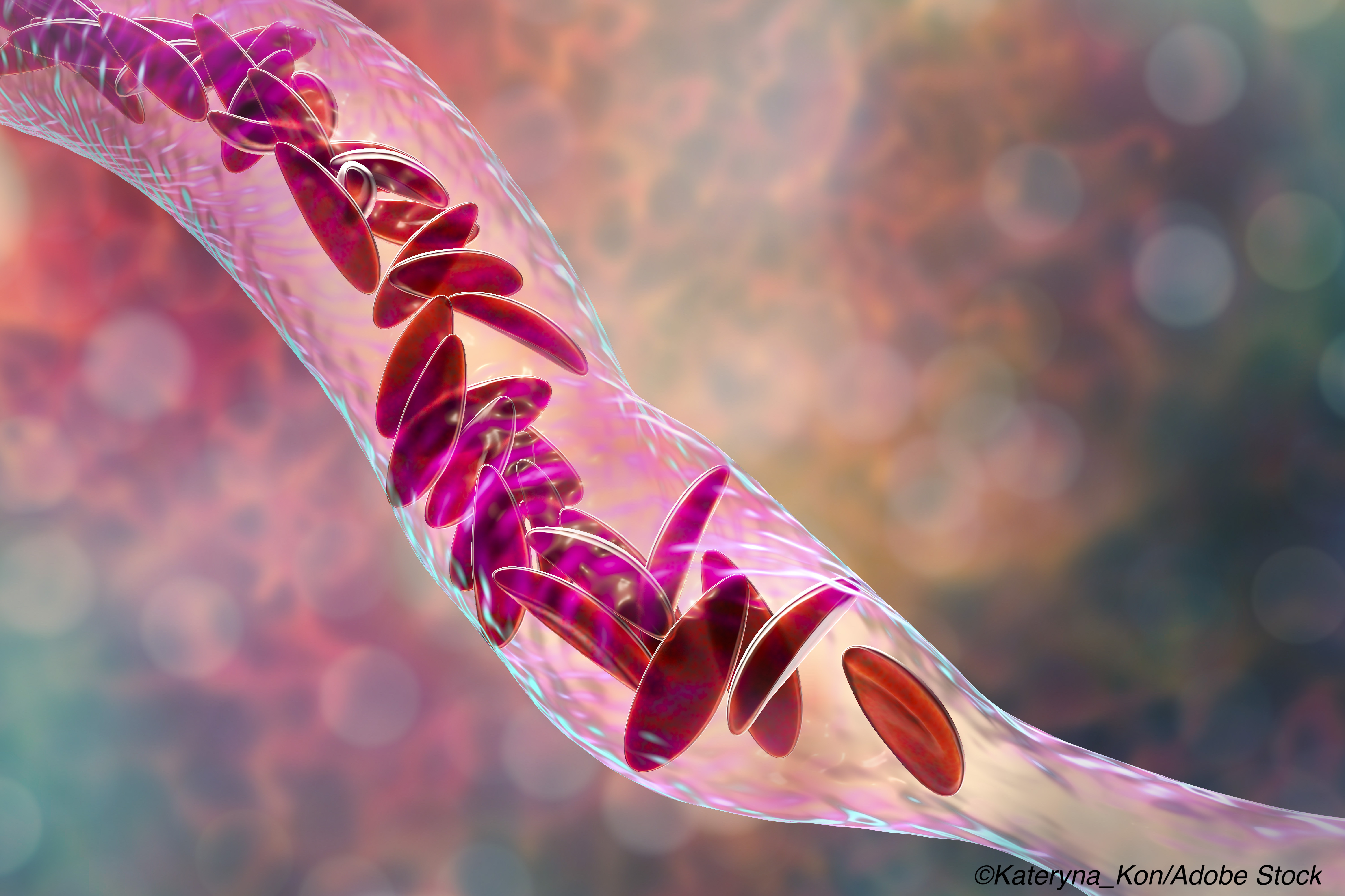 Misdirected Mitochondrial DNA May Trigger Inflammation in Sickle Cell Disease