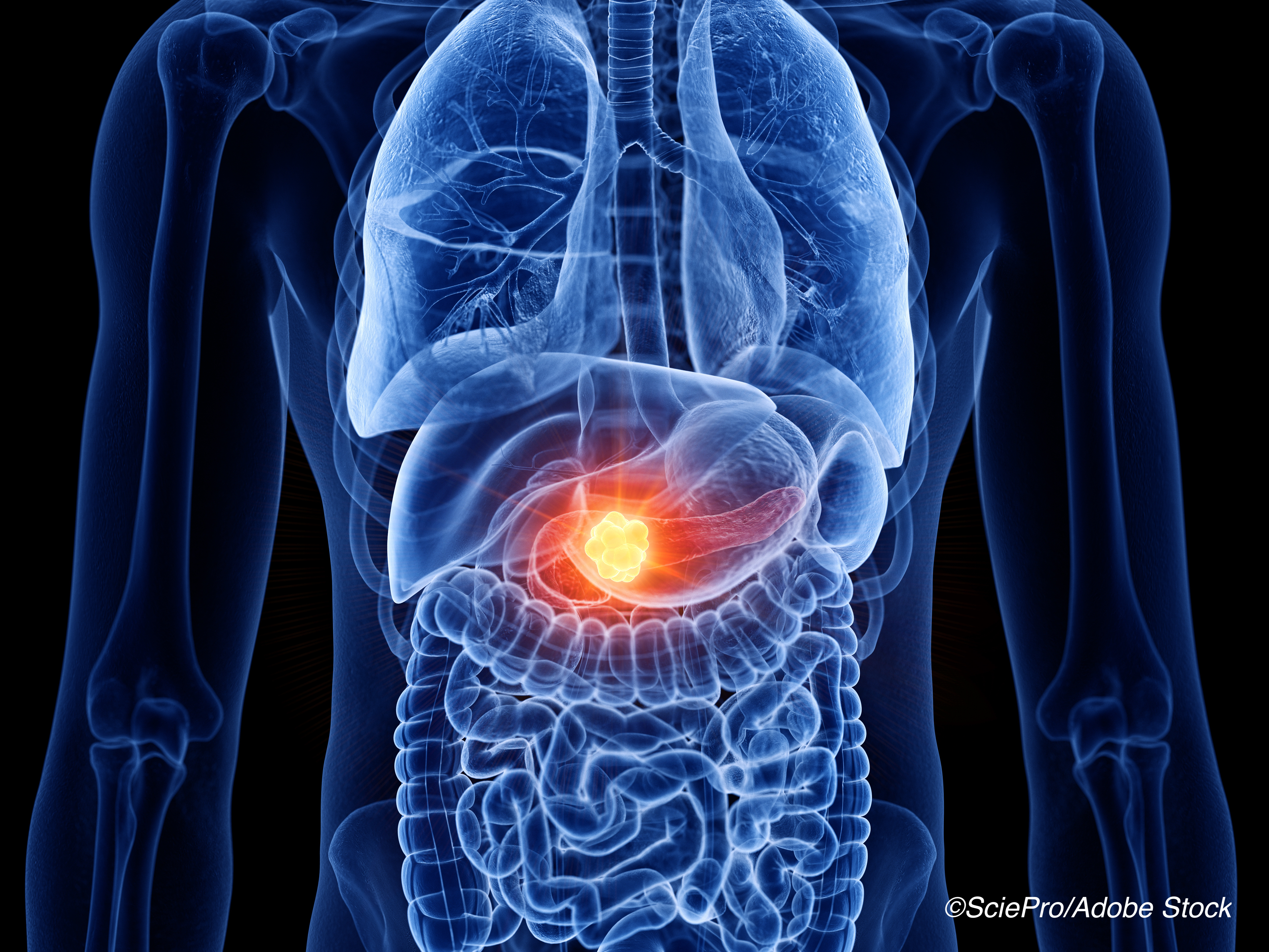 Ablative Radiation Tx for Advanced Pancreatic Cancer: Durable Tumor Control, Improved Survival