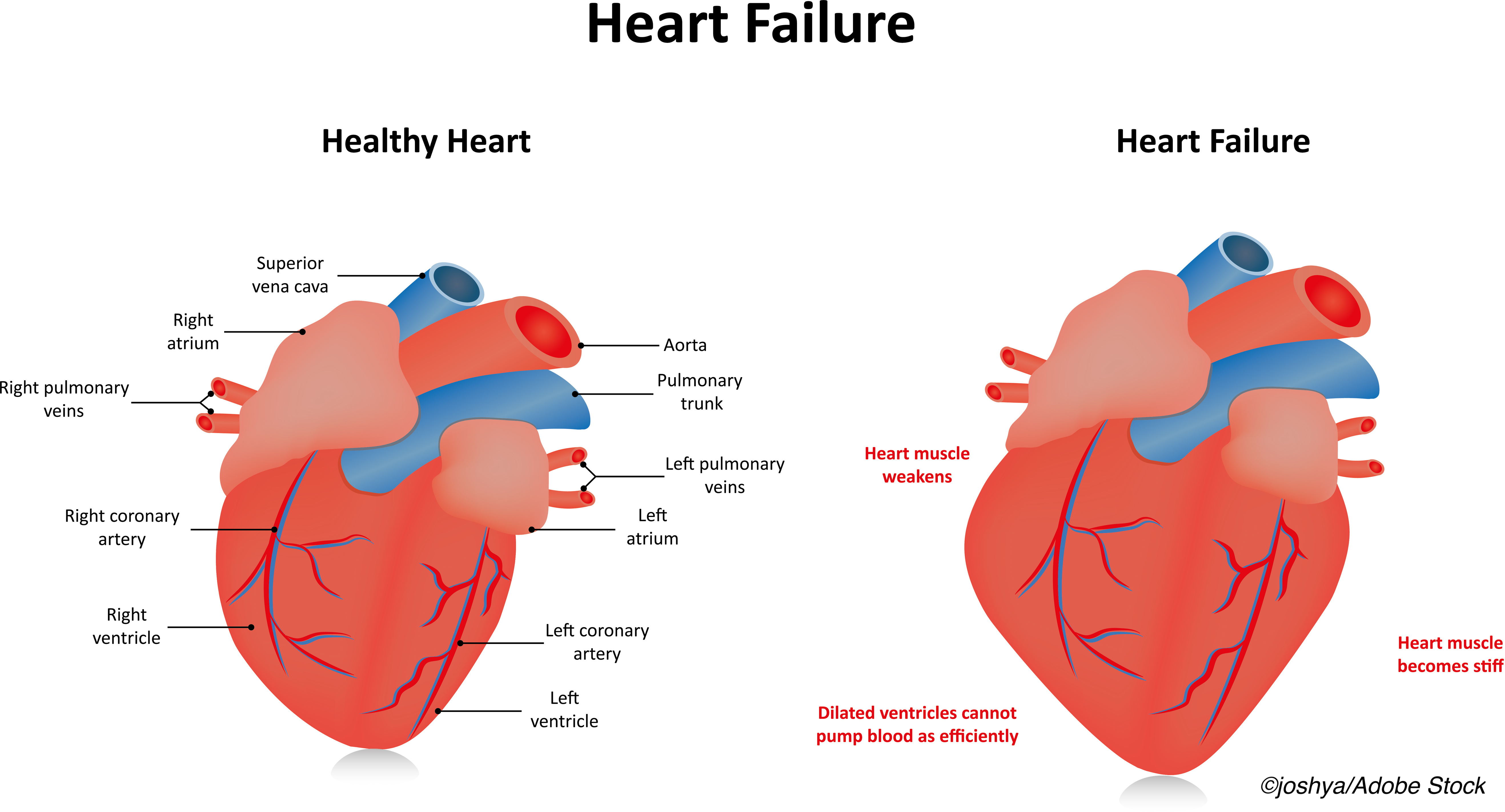 Incident Heart Failure Its Not Just Lvef Anymore Physician S Weekly