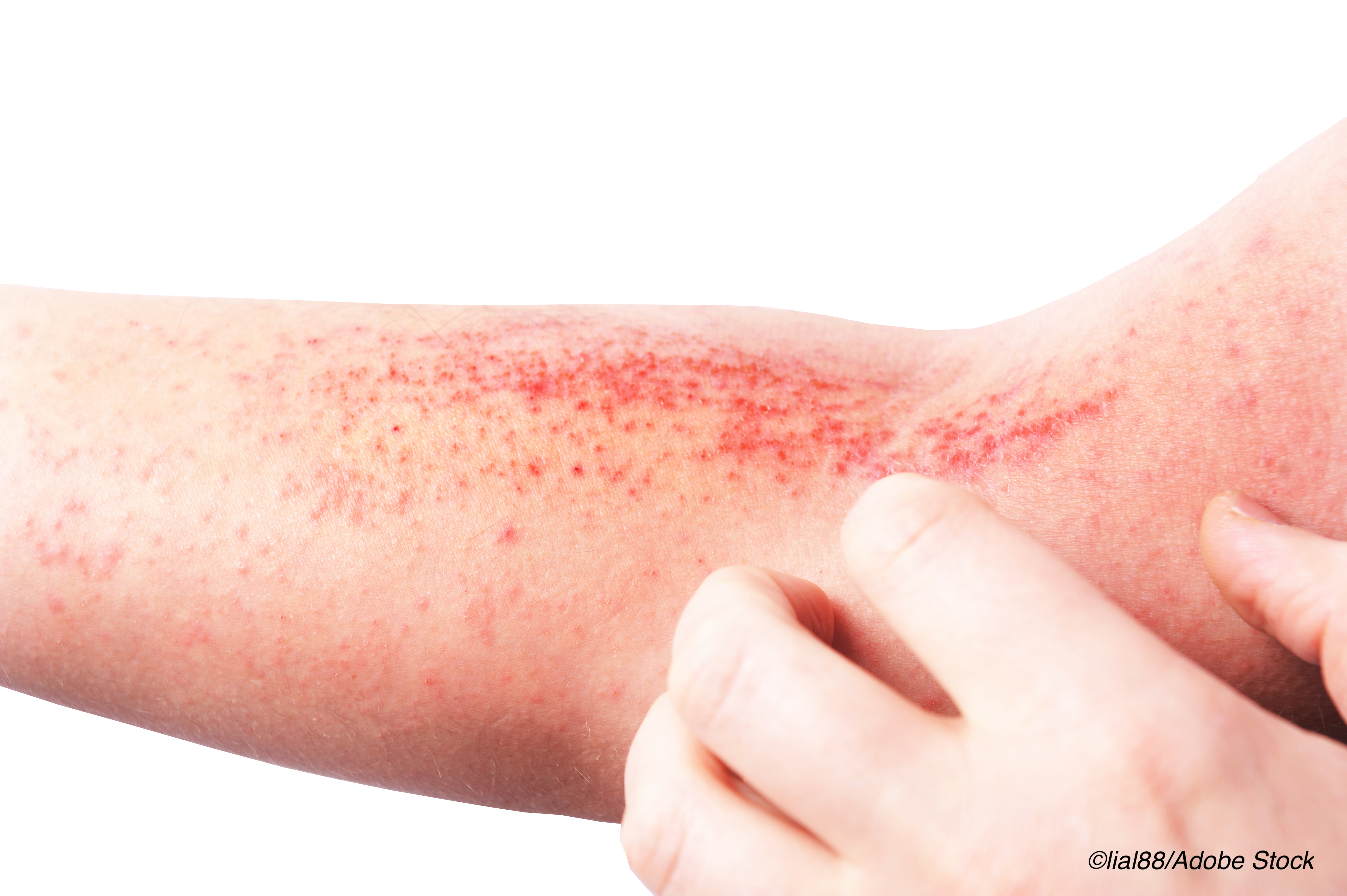 Abrocitinib for Atopic Dermatitis Safely Reduces Symptoms, Itch