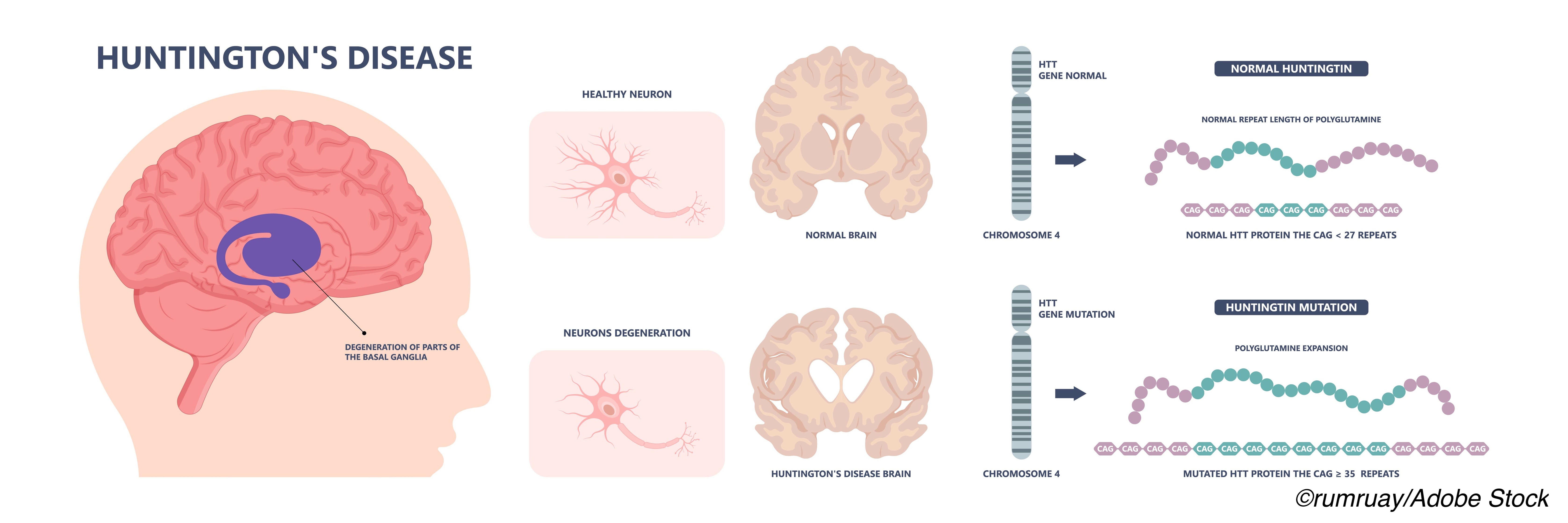 Huntington’s Disease Symptoms Vary By Age at Onset Physician's Weekly