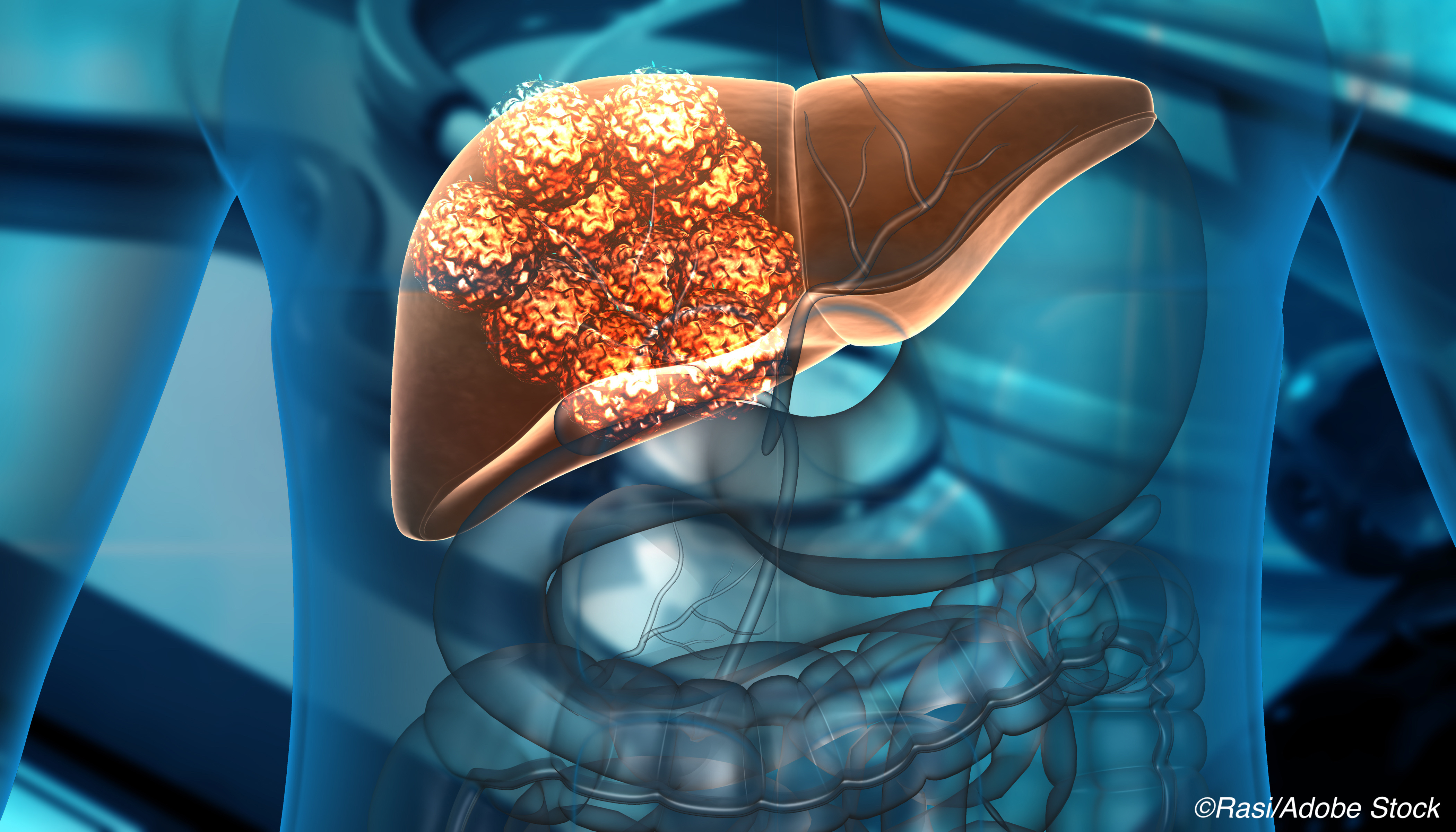 Study Results Raise Possibility of Liver Transplant as Tx Option for Advanced CRC Liver Metastasis