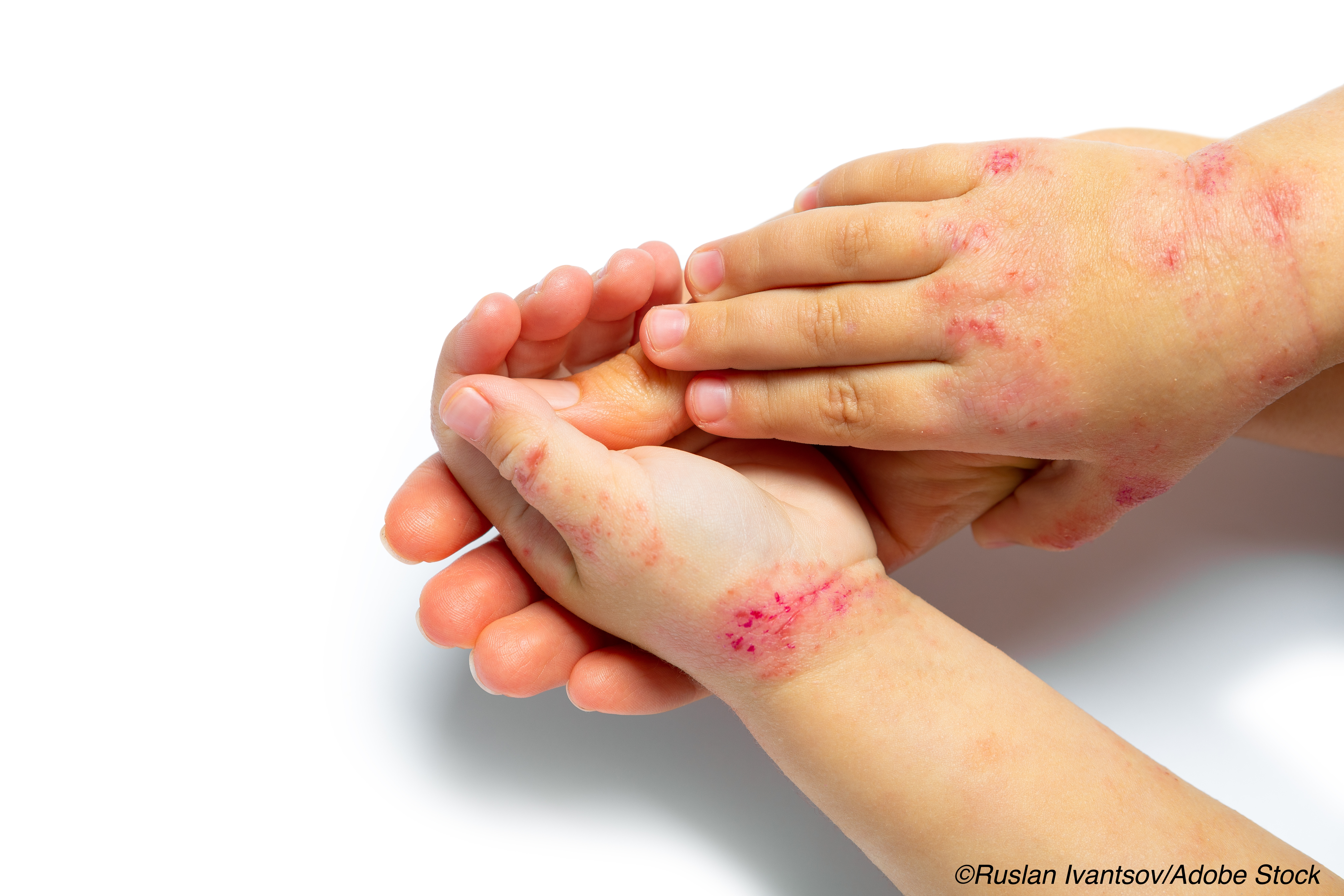 Children with Eczema at Greater Risk for Learning Disabilities