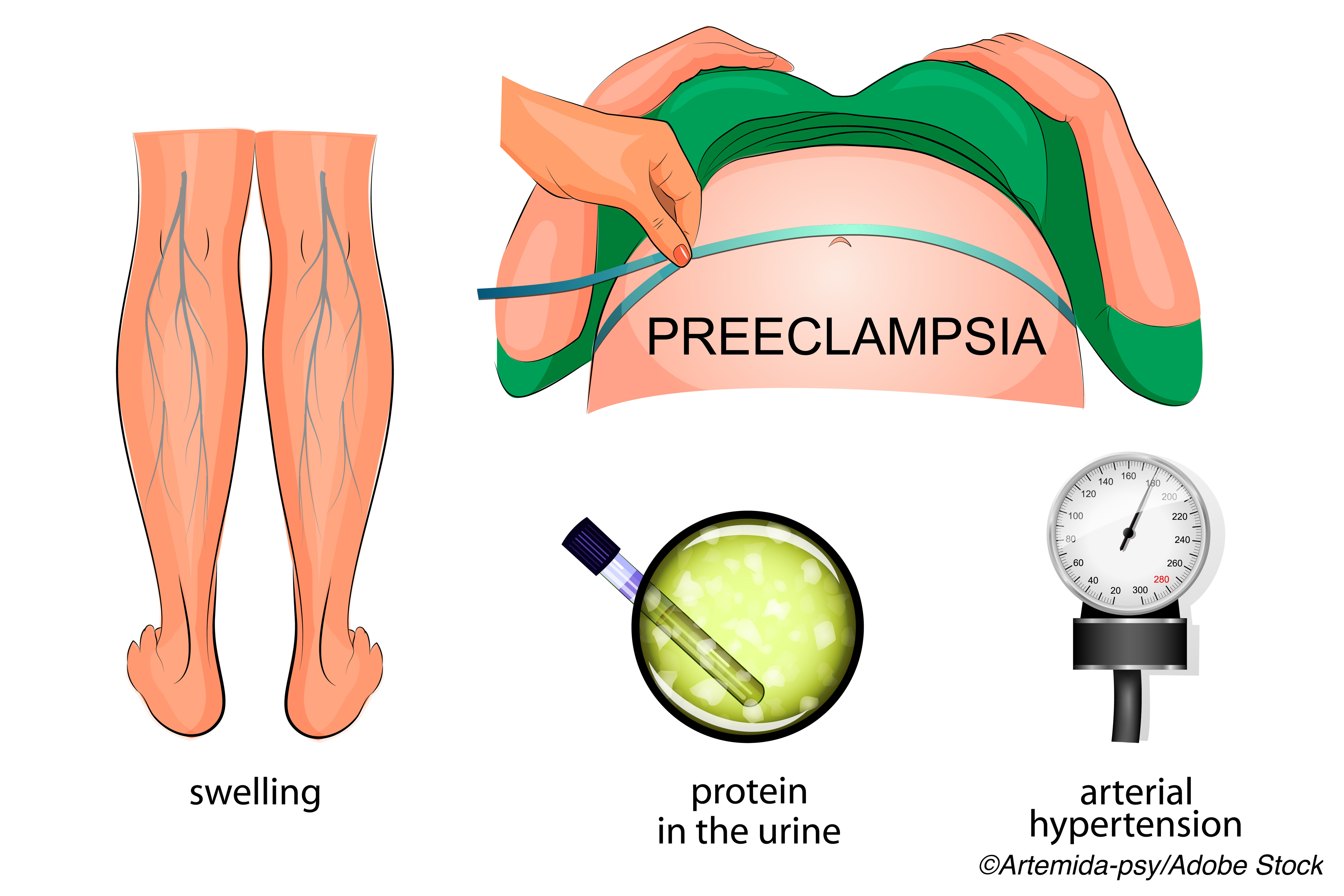 Preeclampsia May Precede Later-Life Stroke in Some Women