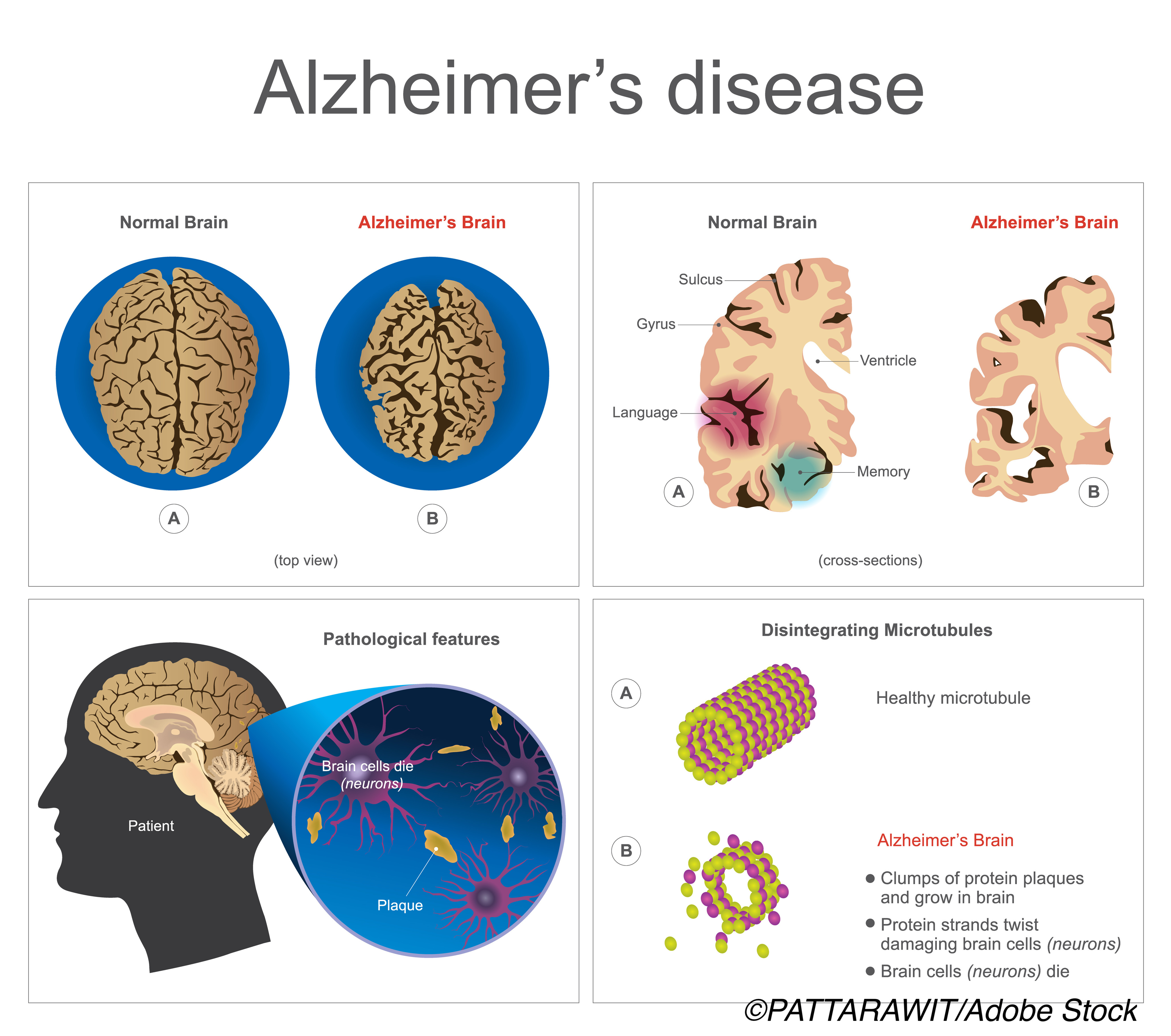 Biomarker Definition of Alzheimer’s Not Ready for Everyday Use