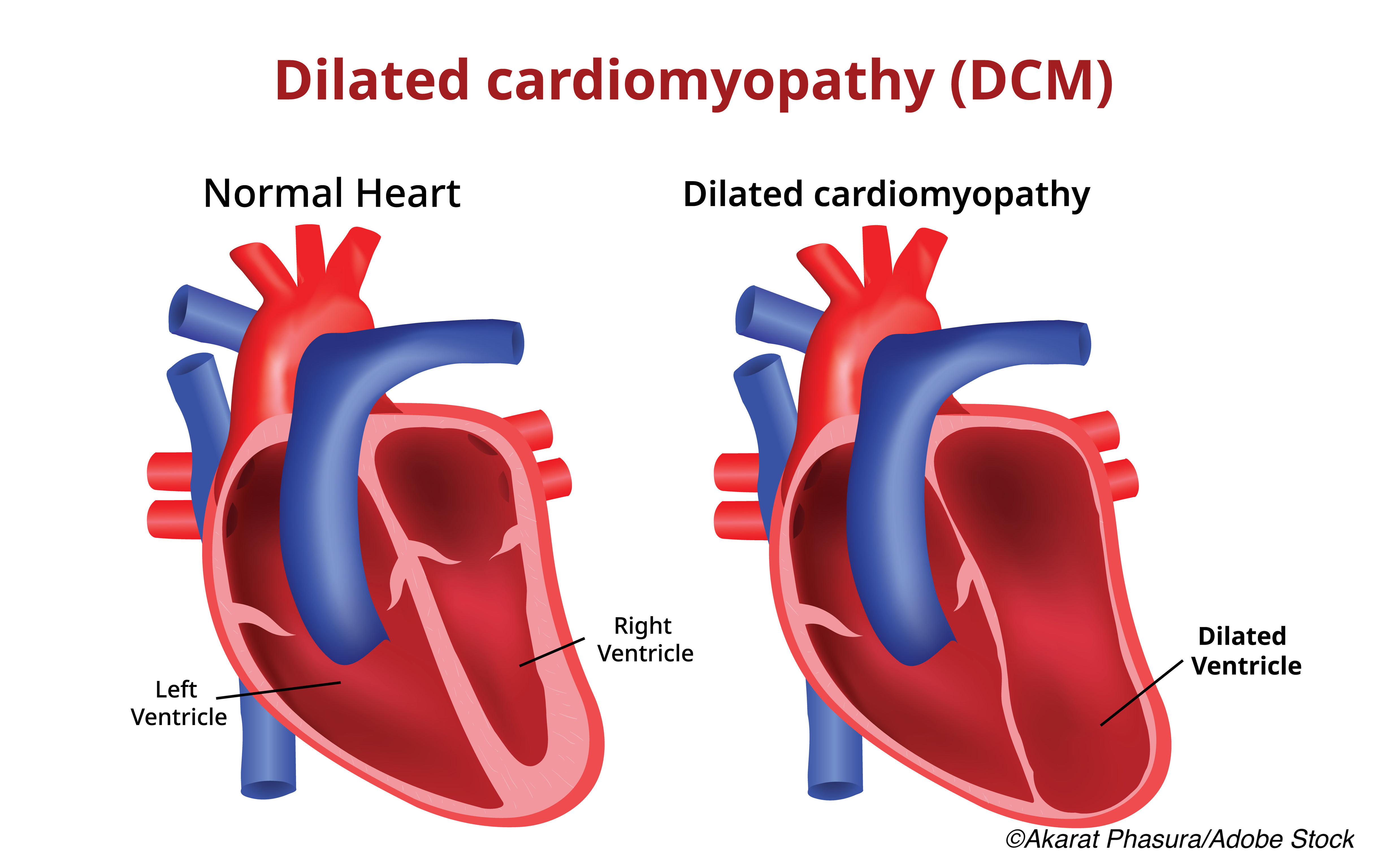 Genetic Profile Refines Risk of SCD in Patients with Left Ventricular  Systolic Dysfunction - Physician's Weekly