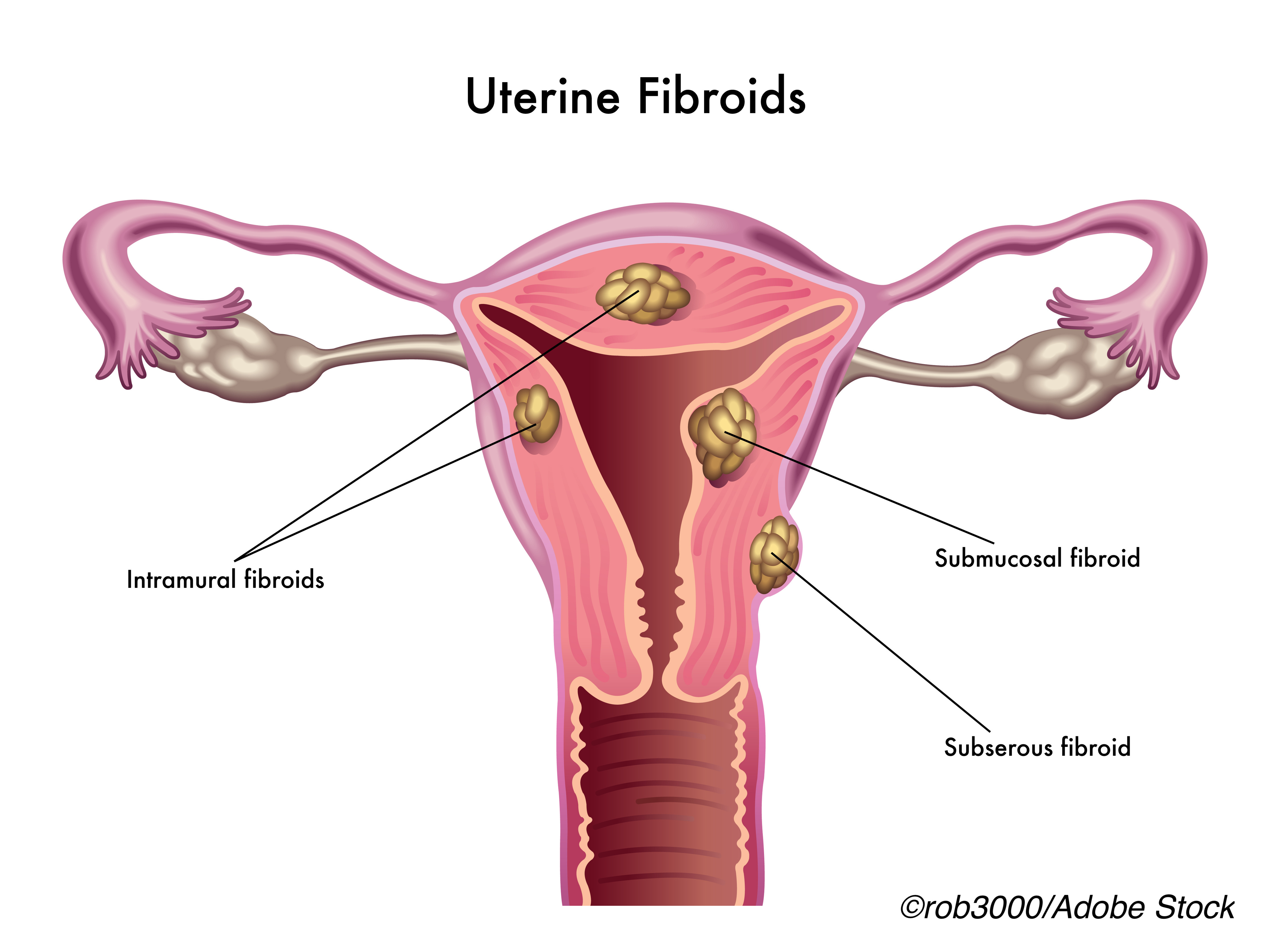 High Ozone Exposure May Increase Uterine Fibroid Risk in Black Women