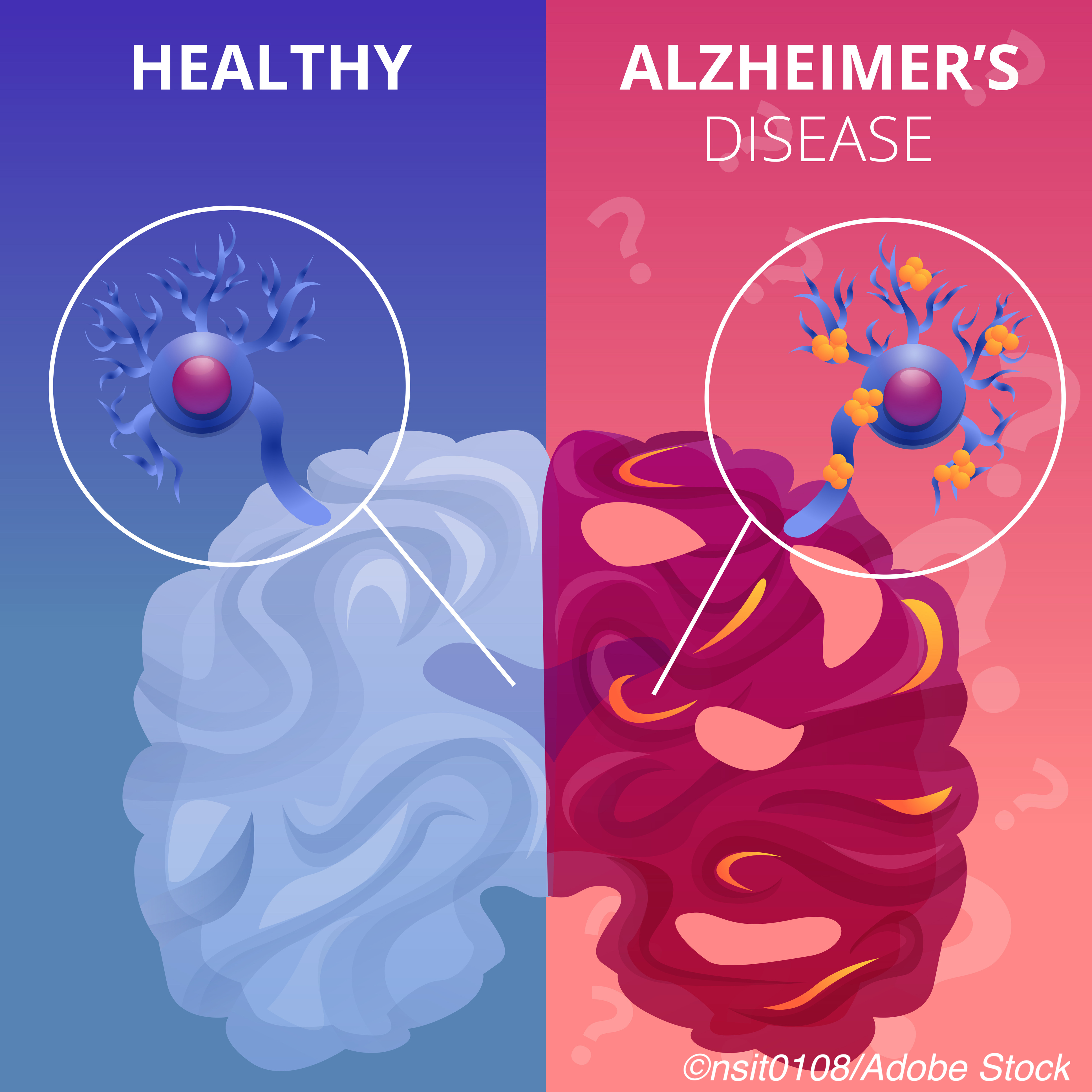 International Working Group: Biomarkers Alone Not Enough for Alzheimer’s Dx