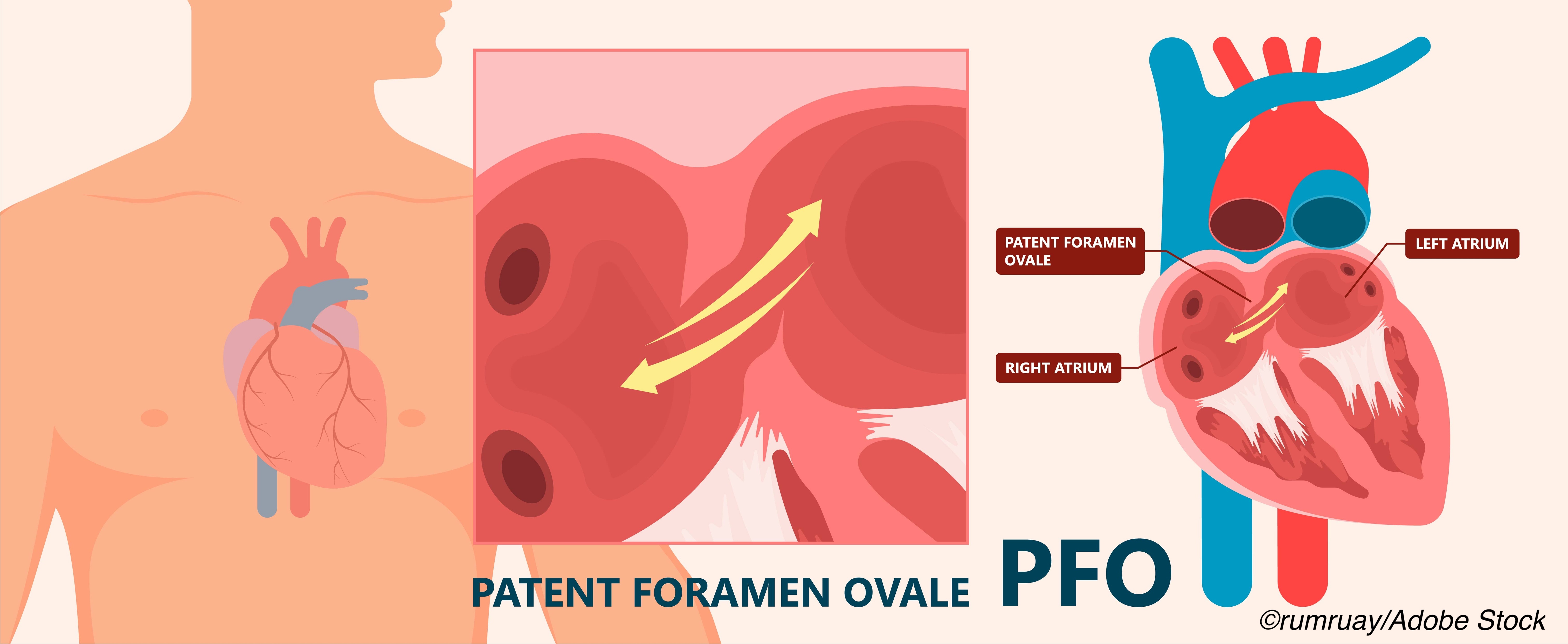 Patent Foramen Ovale (PFO): Symptoms, Causes & Treatment