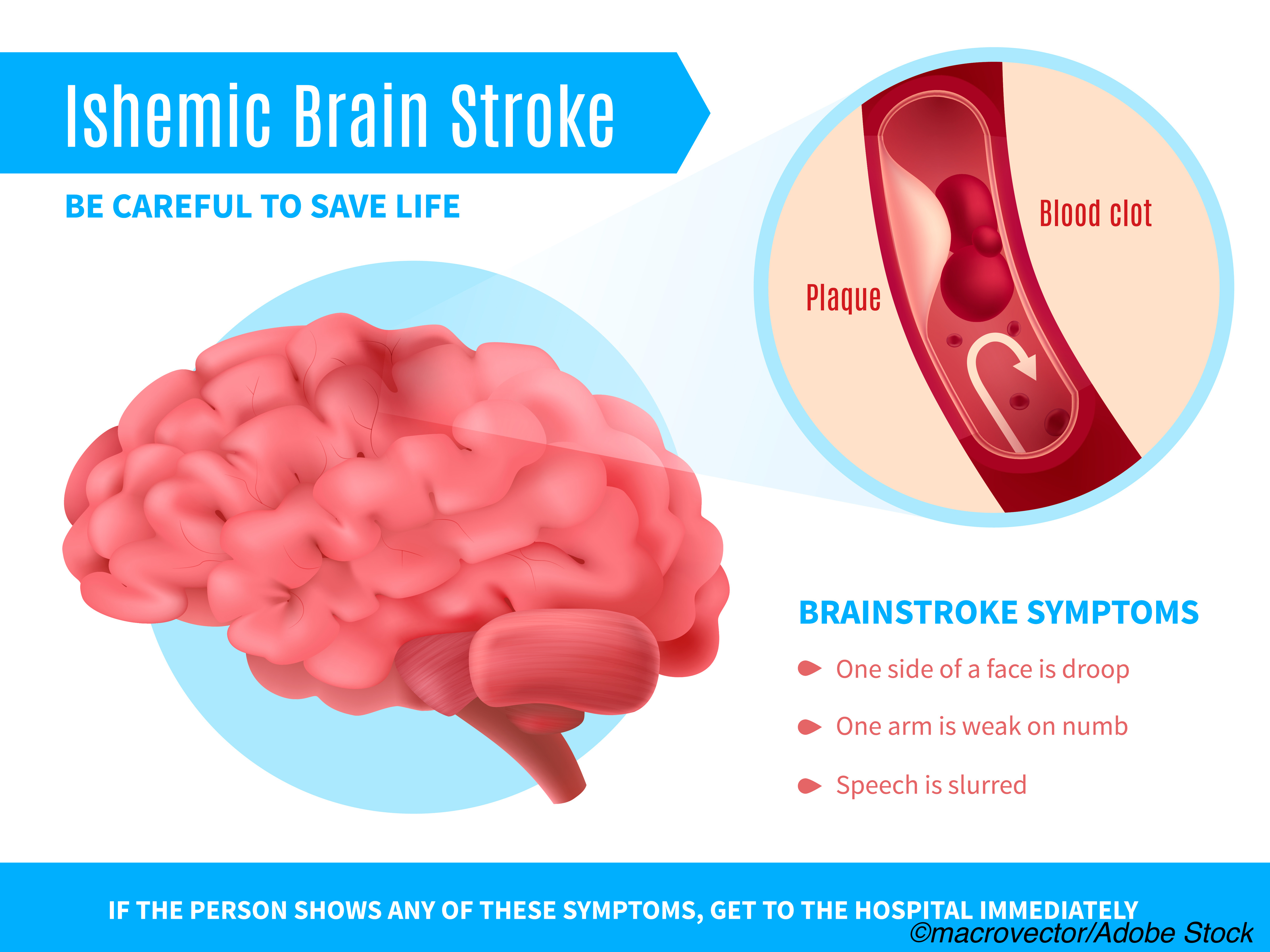 Is Brain Ischemia A Stroke