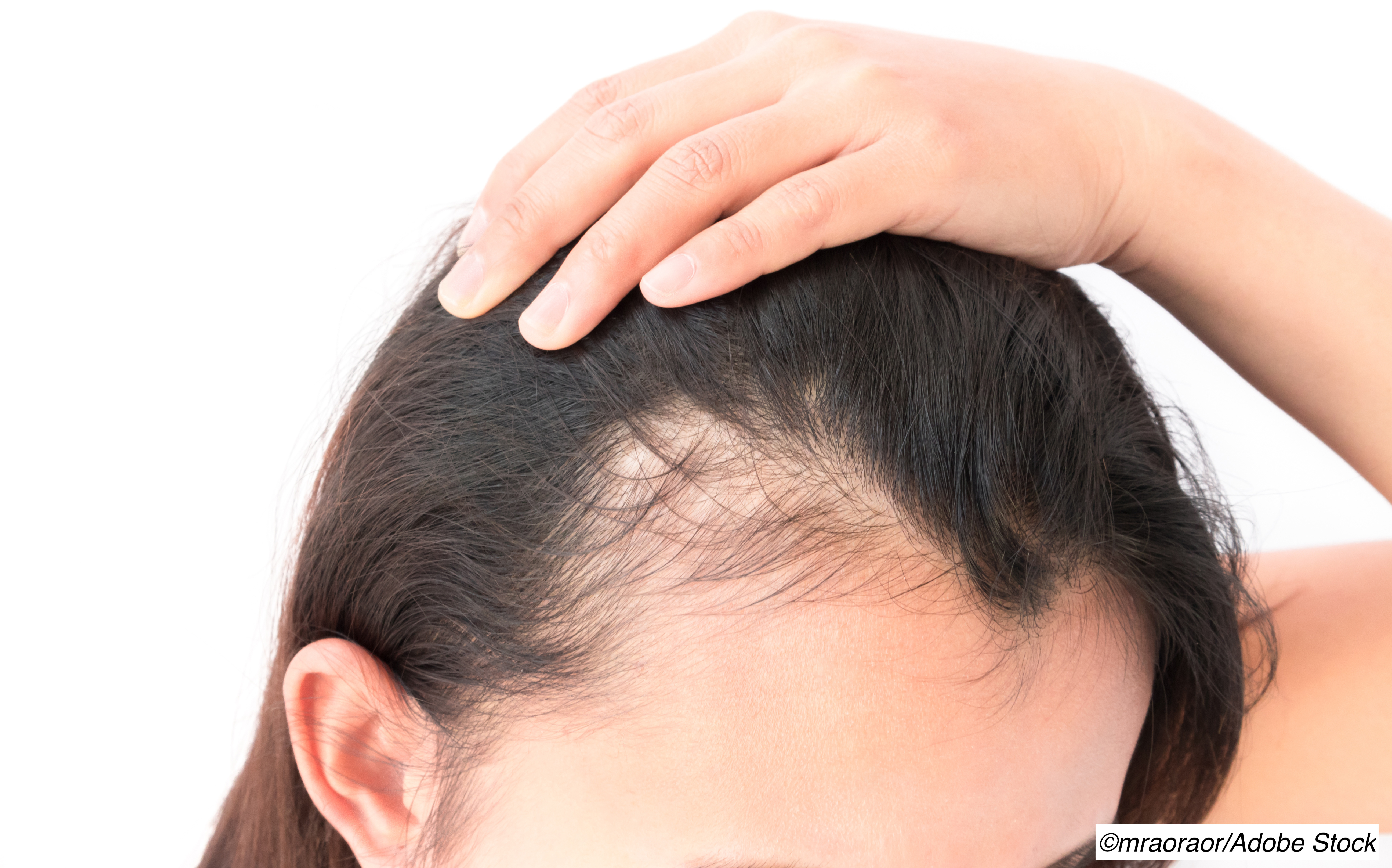 Low-Dose Safe Hair Growth - Physician's Weekly