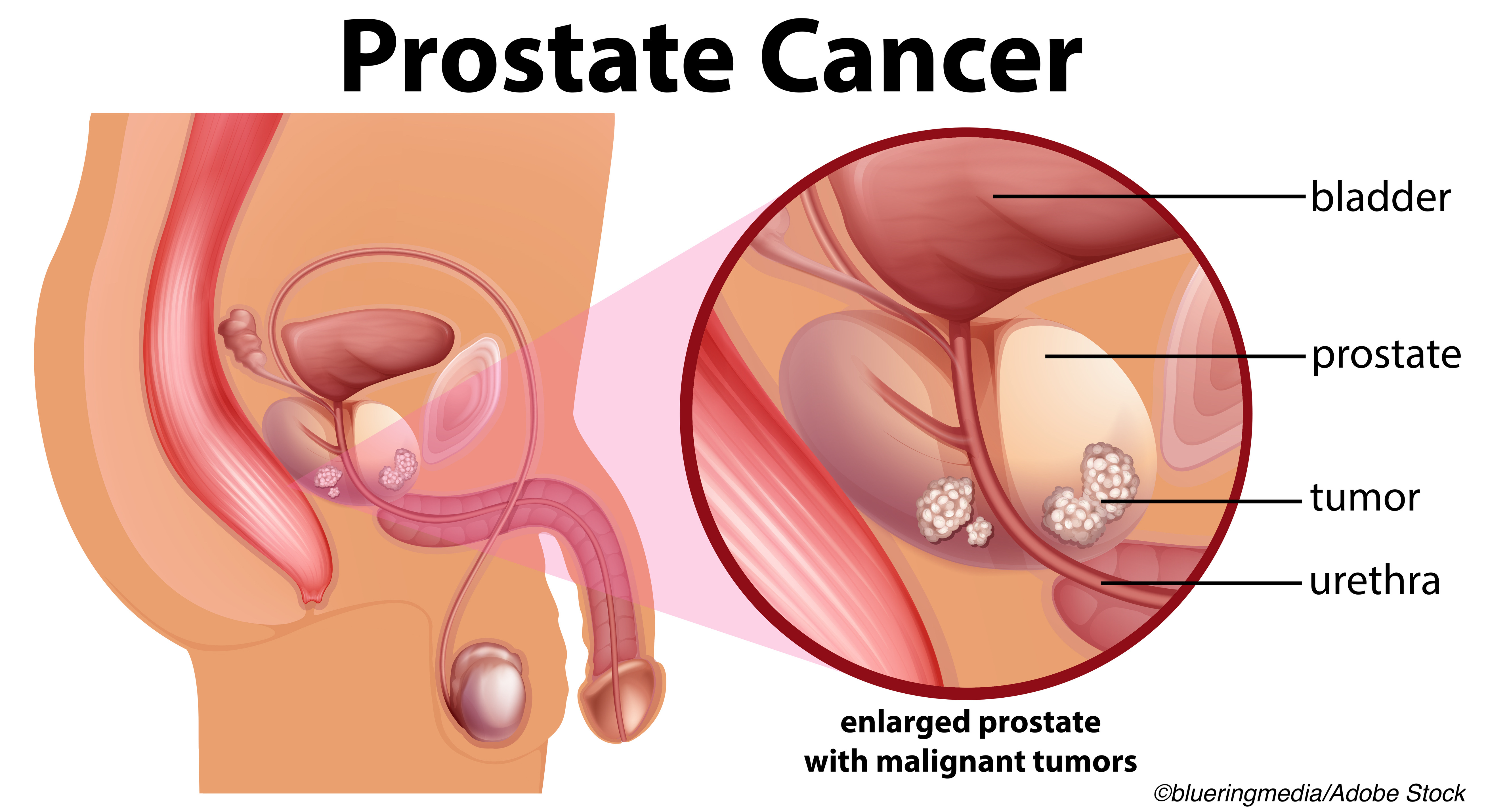 ASCO: Targeted Radiation Improves Prostate Cancer Outlook