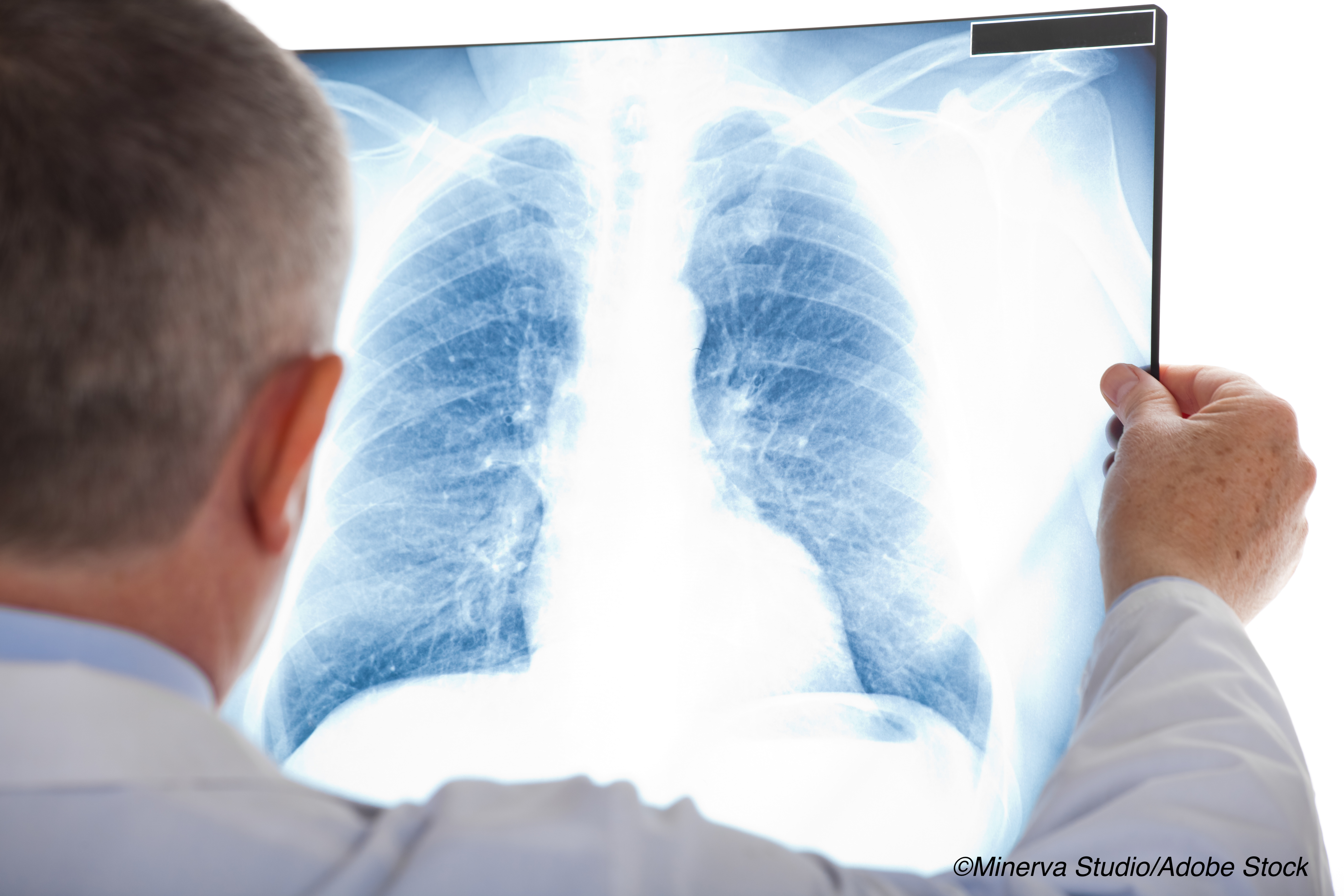 Pembro-Chemo Combo Holds Promise for Stage III NSCLC