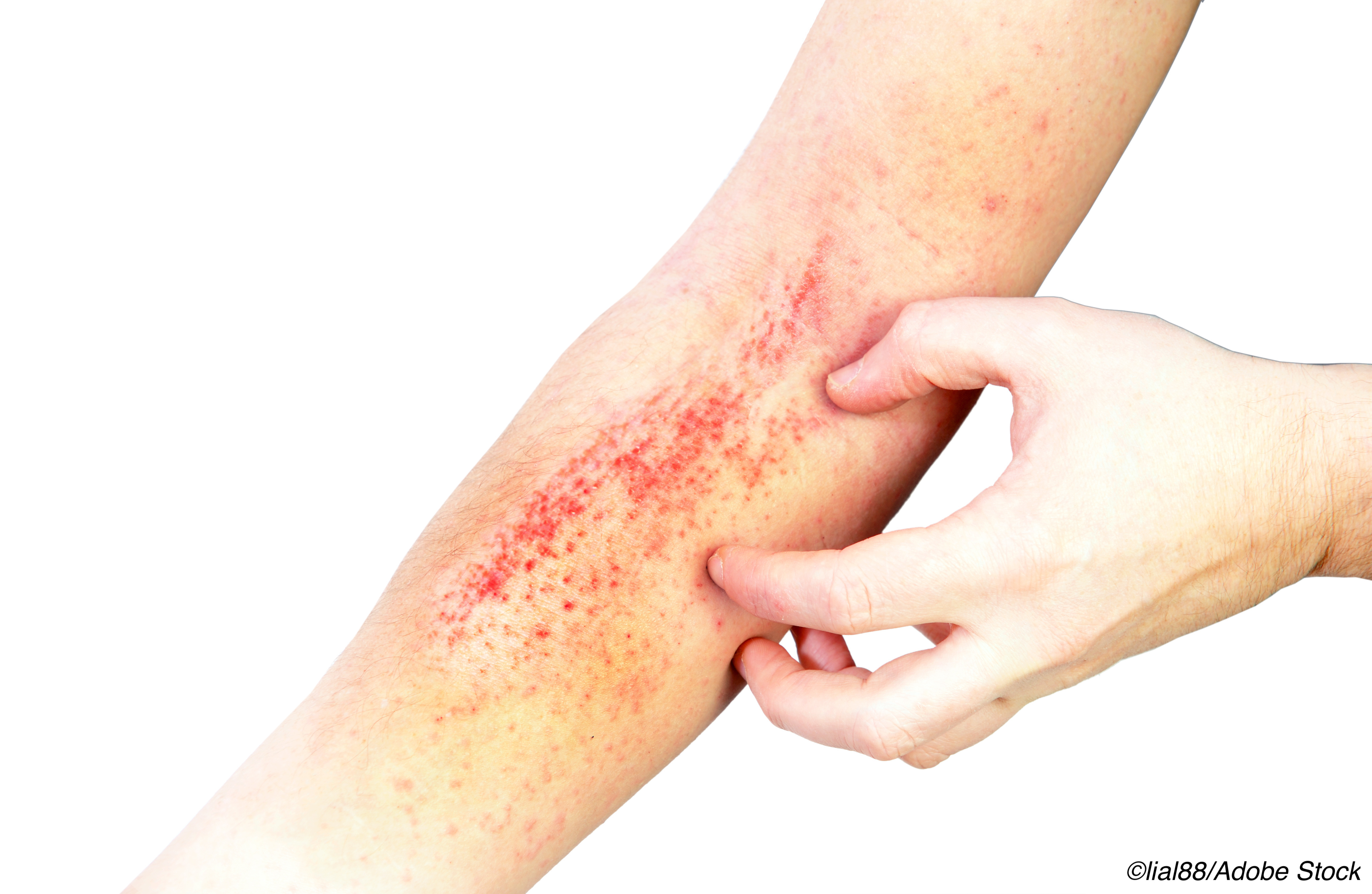 JAK Inhibitor Safe, Effective for Treatment of Moderate-to-Severe Atopic Dermatitis