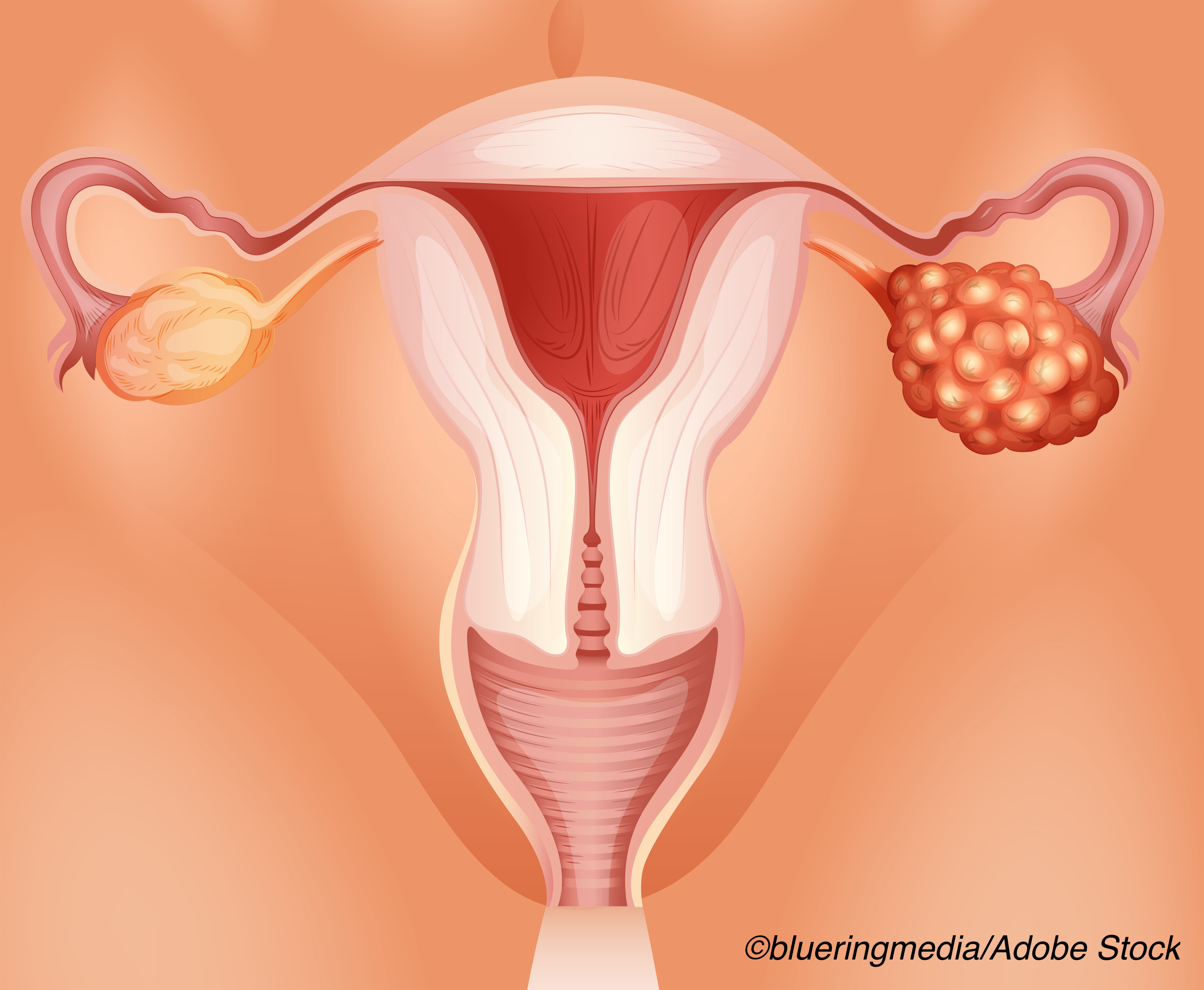 Primary Debulking Surgery Bests Neoadjuvant Chemo in High-Grade Serous Ovarian Cancer