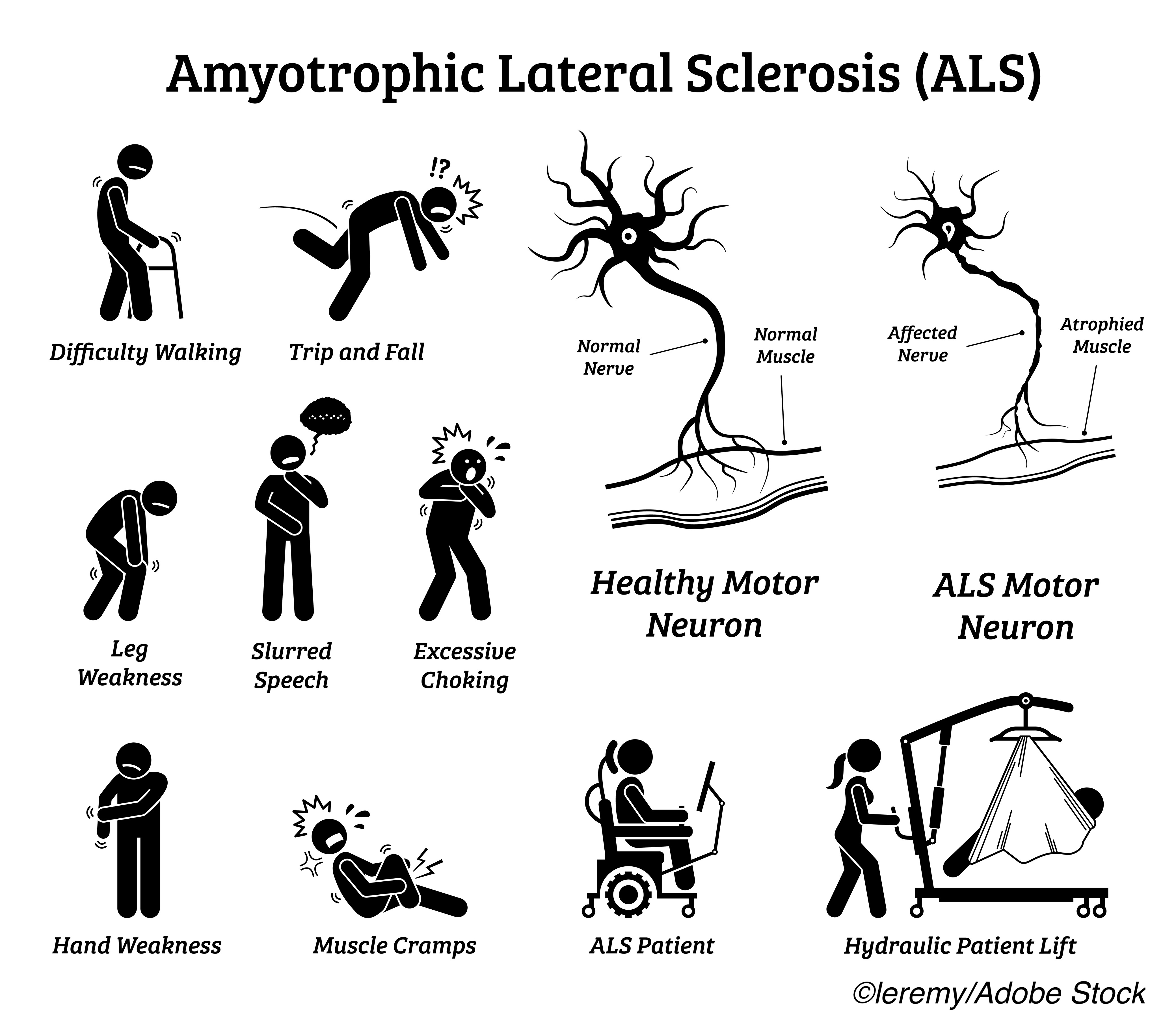 Gene Mutations Still a Factor in ALS Patients without Family History