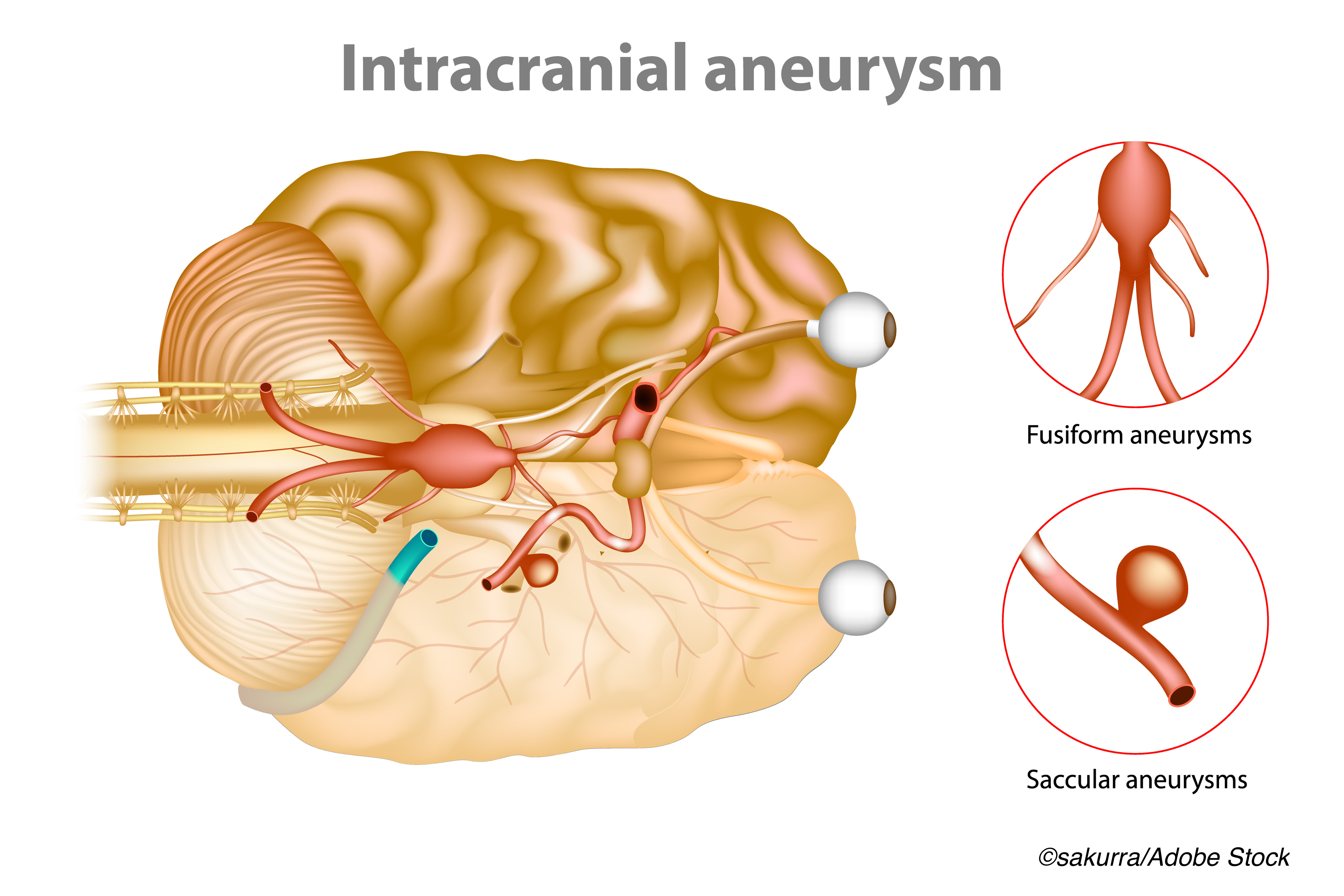Magnesium Linked to Intracranial Aneurysm