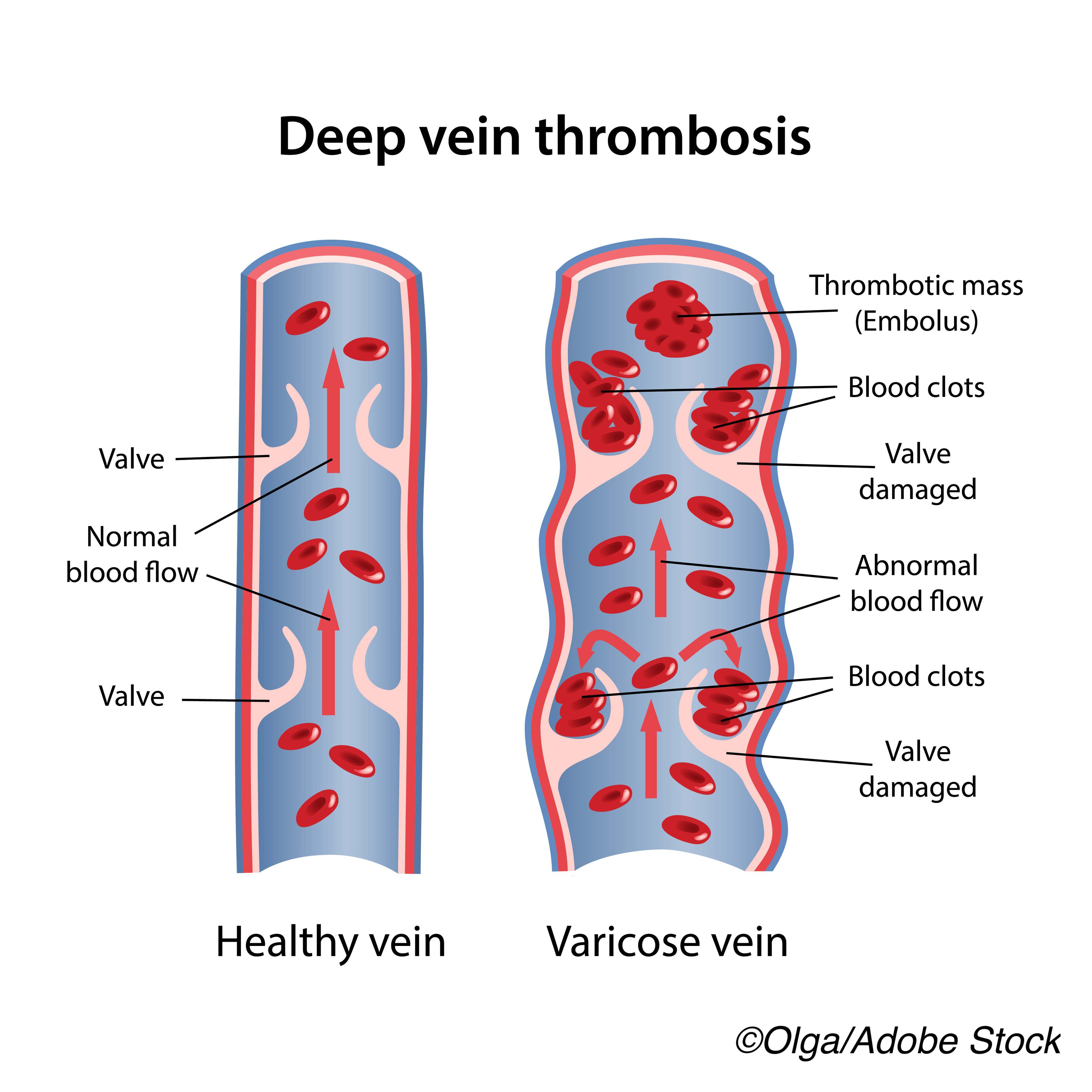 Covid 19: Thrombosis After mRNA Vax Rare, But Possible