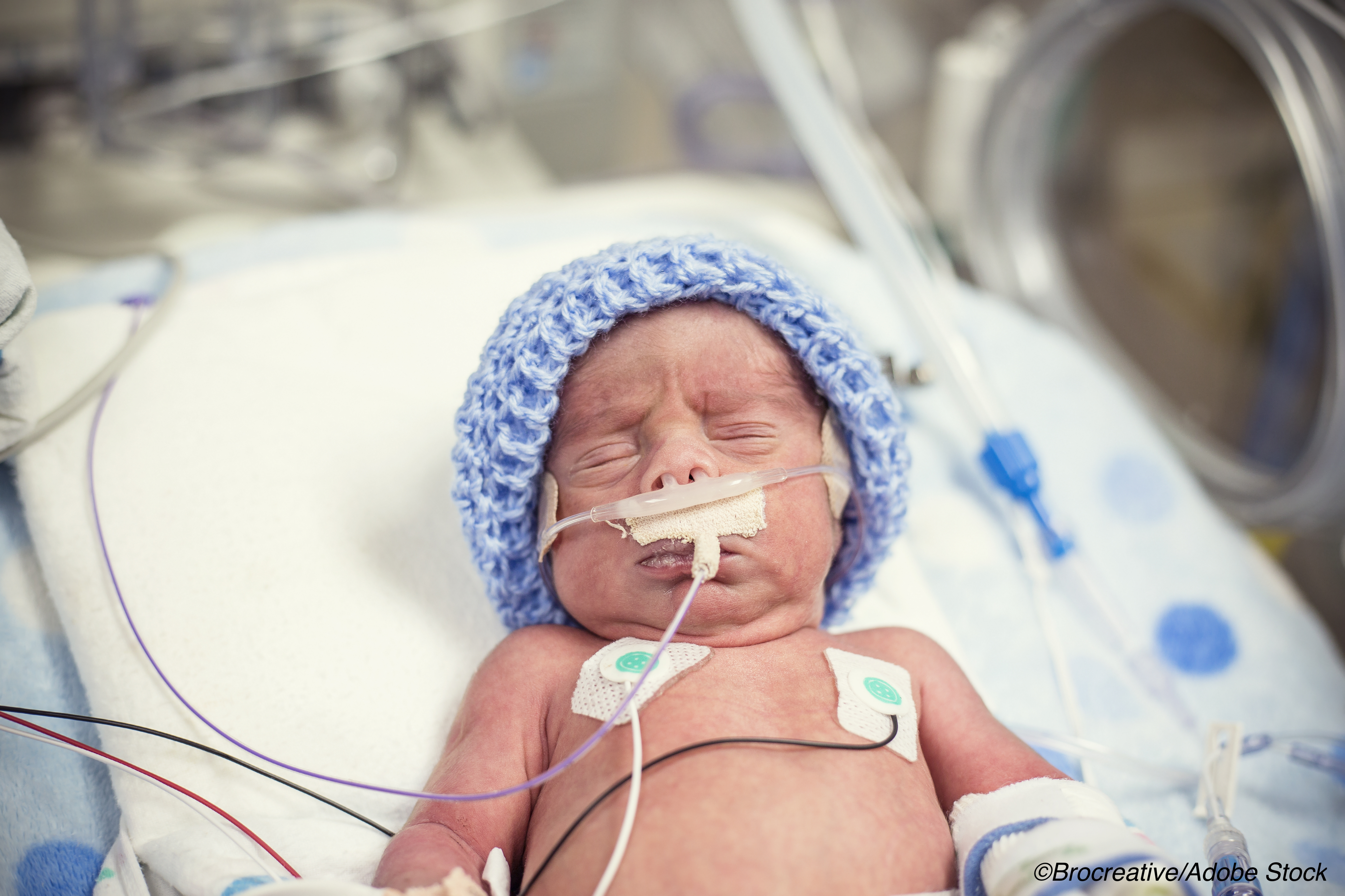 Notable Drop in Use, Duration of Mechanical Ventilation in Preemies
